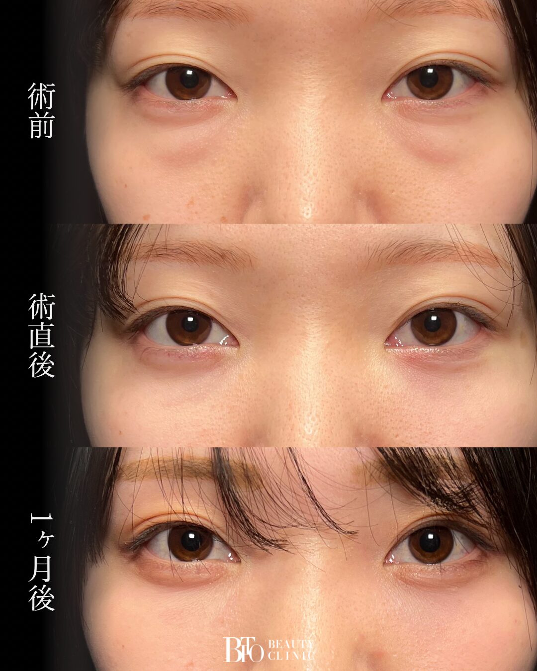 231.切らないクマ取り(脱脂術)