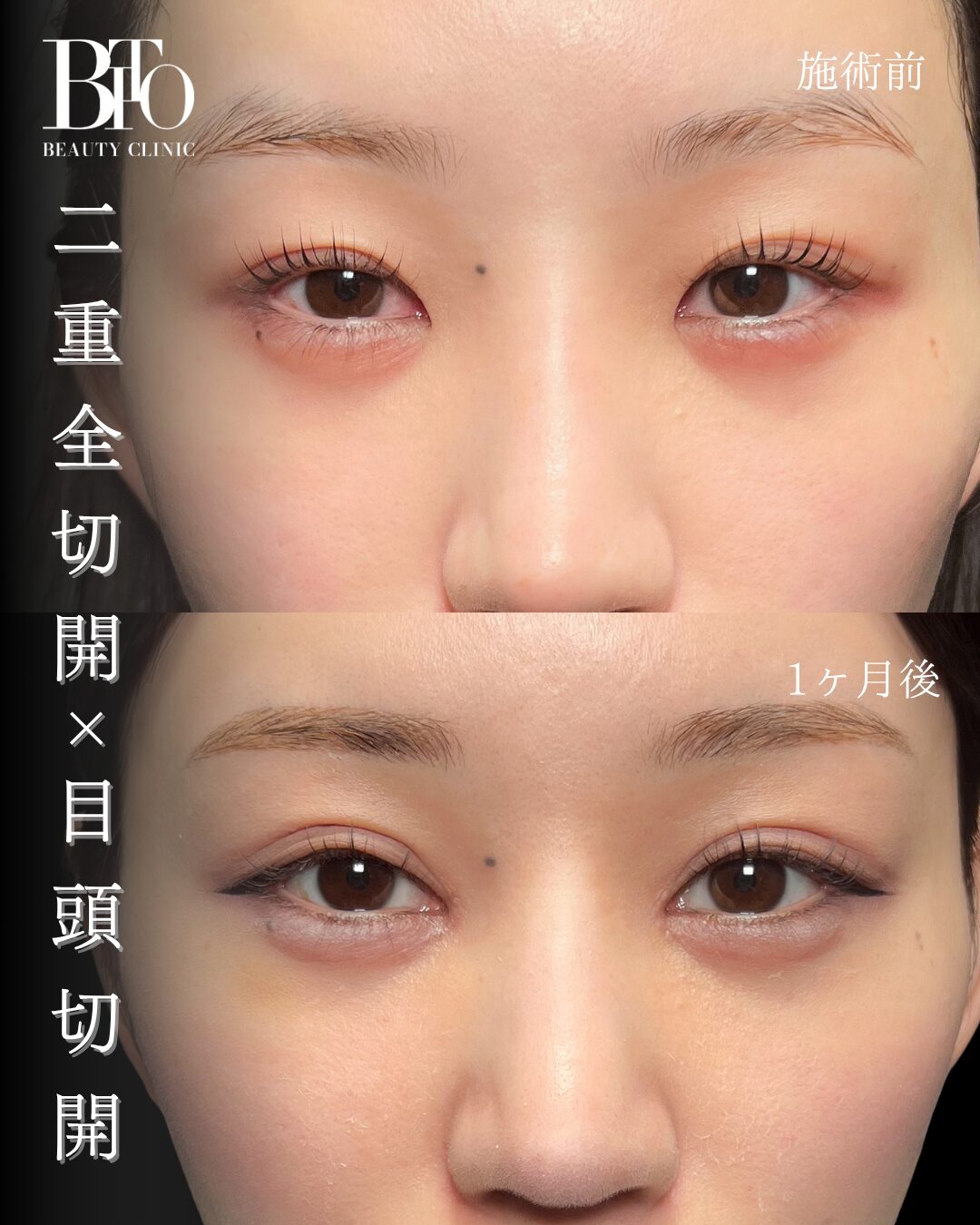 226.20代女性 二重全切開・目頭切開