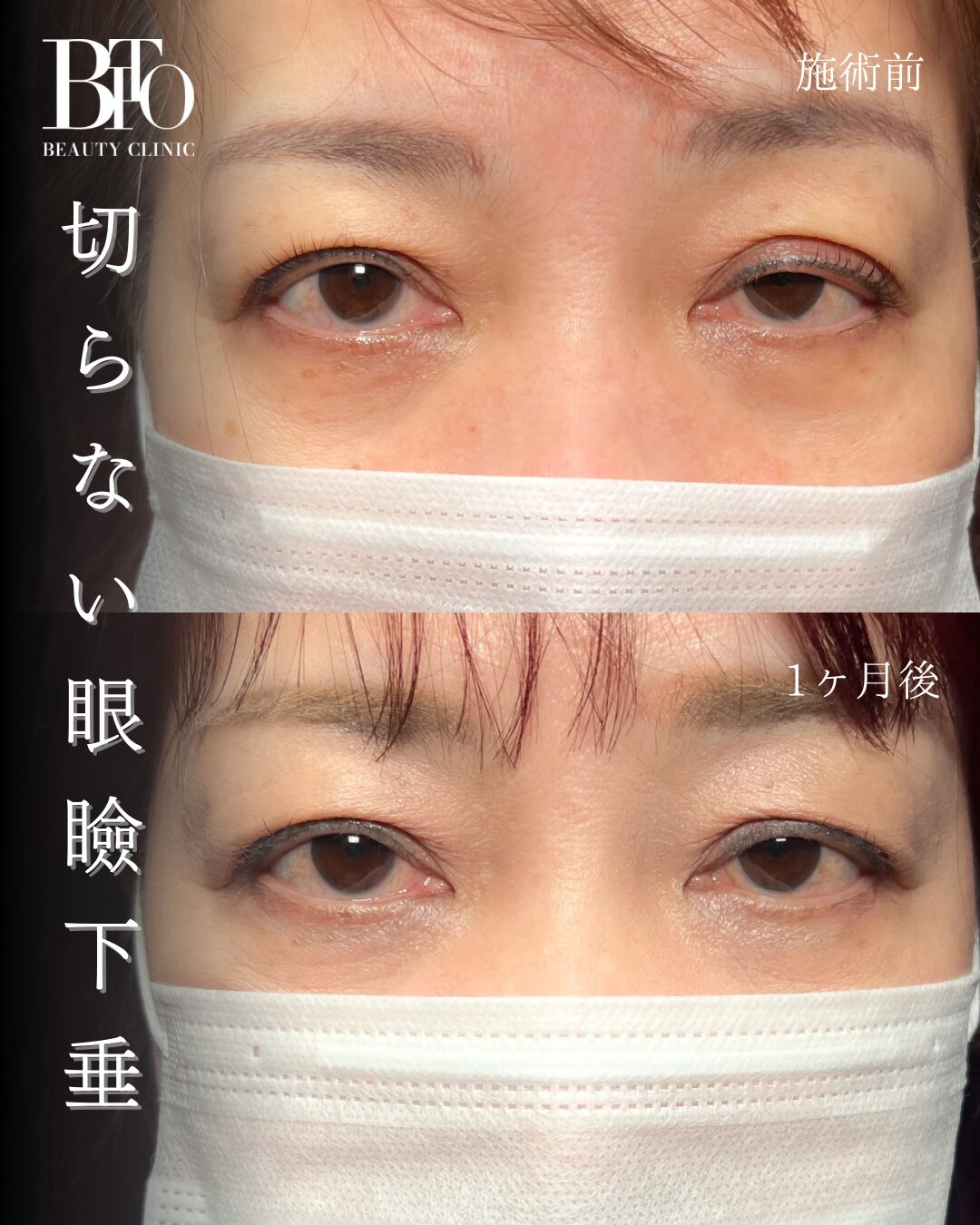 229.切らない眼瞼下垂