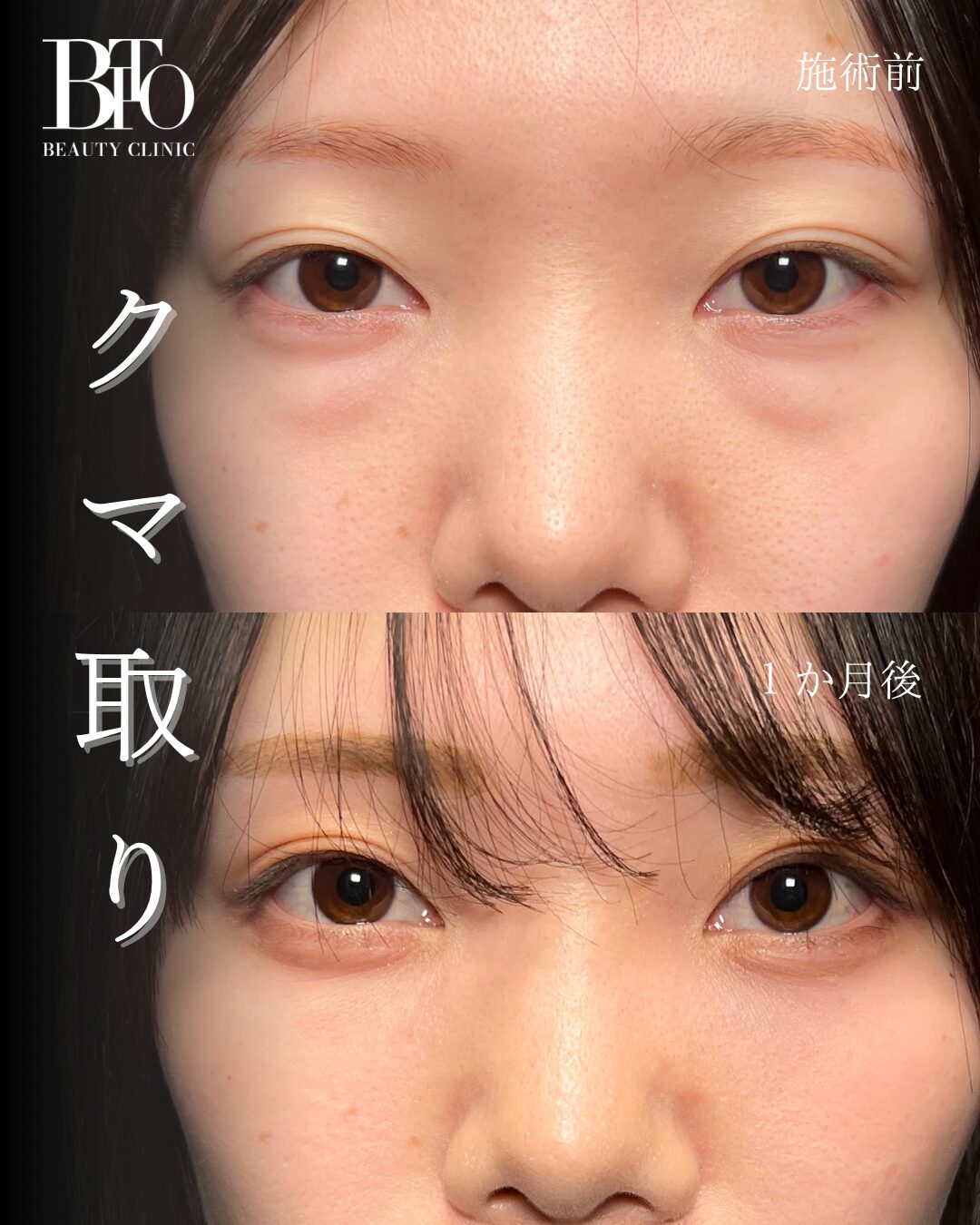 231.切らないクマ取り(脱脂術)