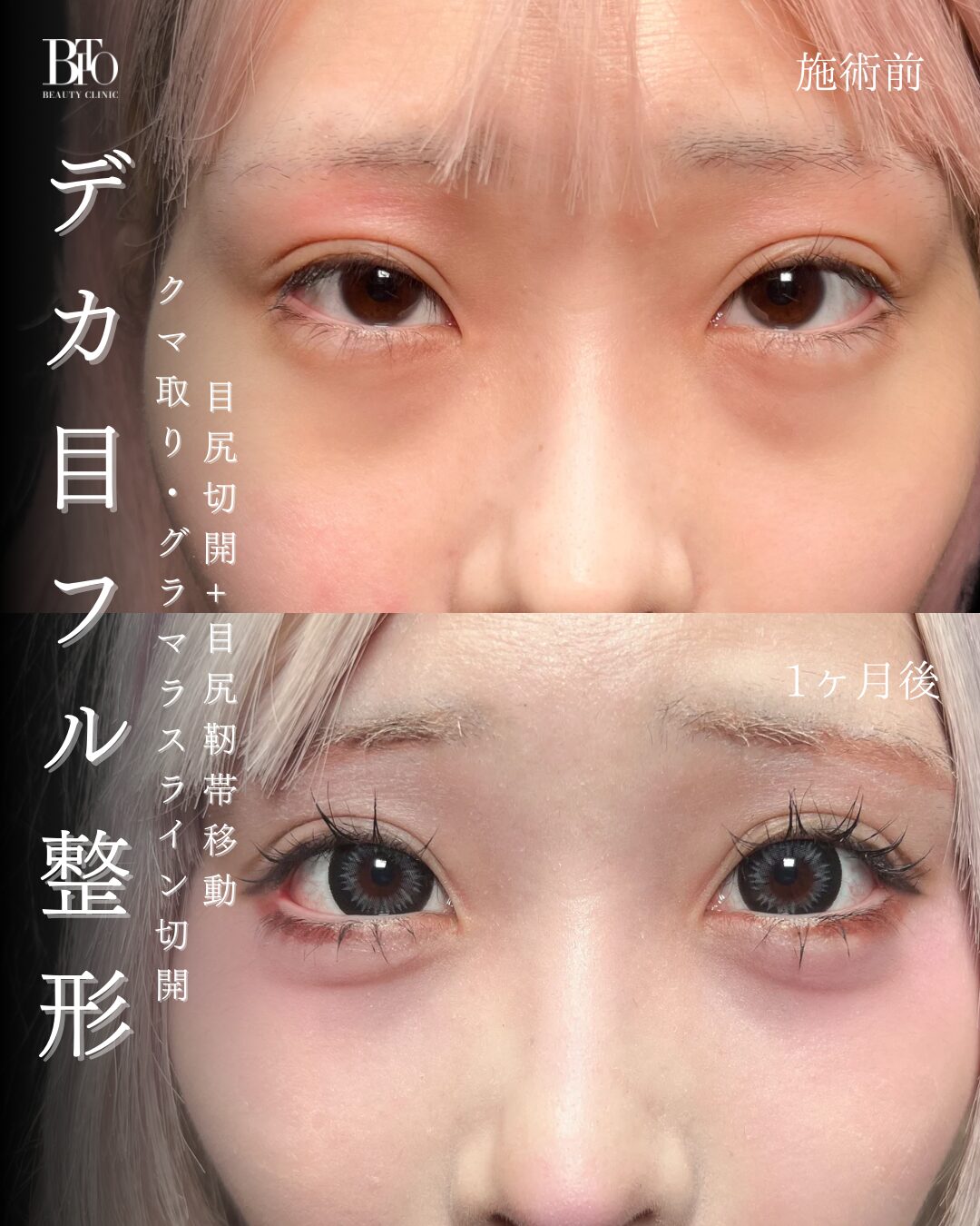 232.目尻切開+目尻靭帯移動・グラマラスライン切開・クマ取り
