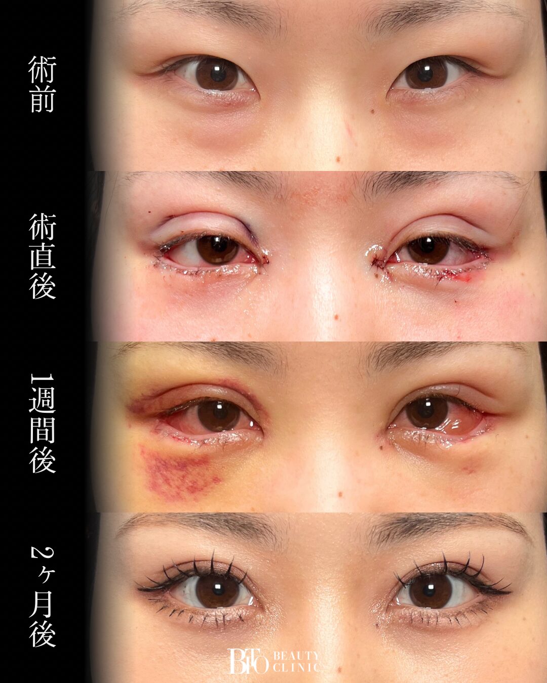 253.目元フル整形
