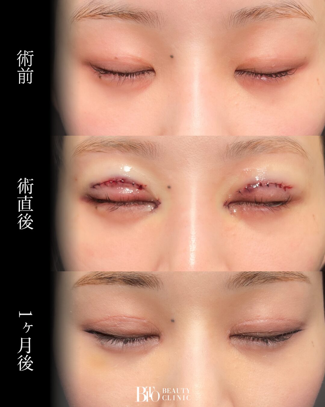 226.20代女性 二重全切開・目頭切開