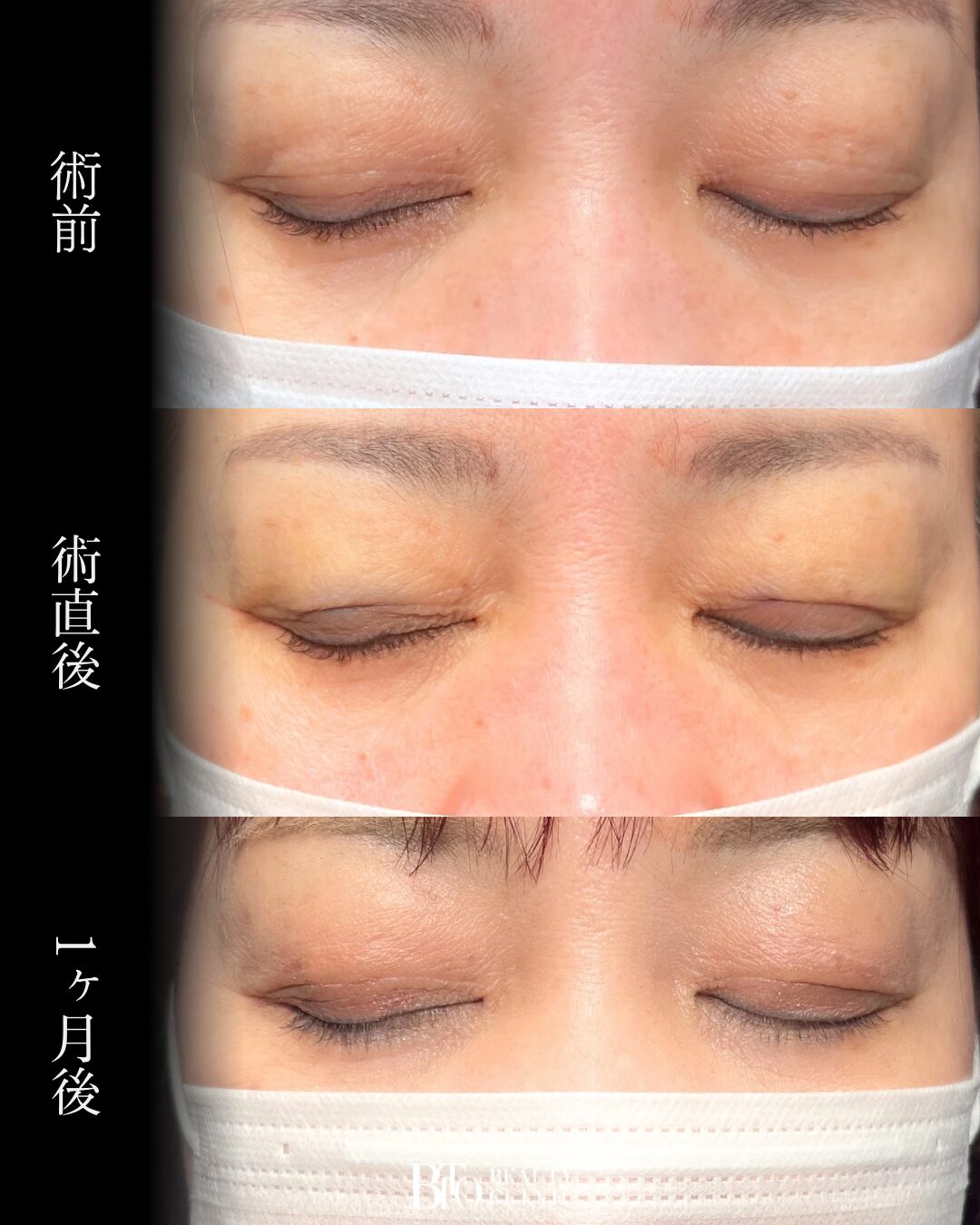 229.切らない眼瞼下垂
