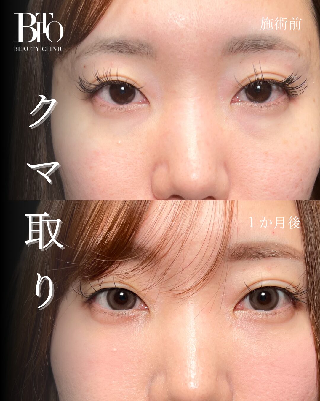 230.切らないクマ取り(脱脂術)