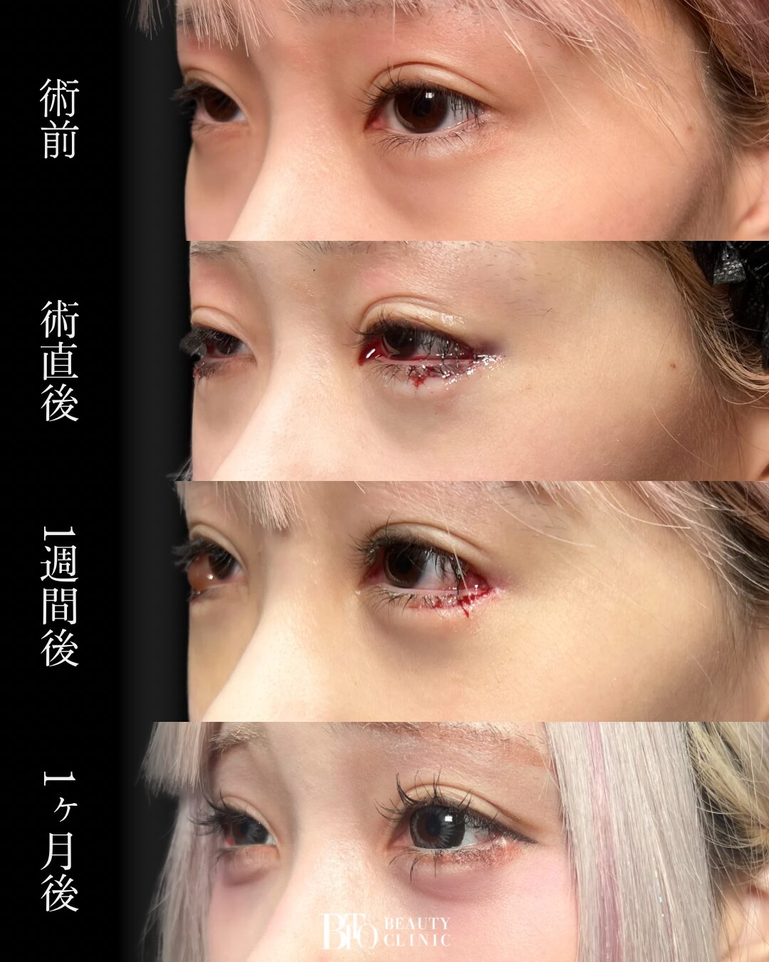 232.目尻切開+目尻靭帯移動・グラマラスライン切開・クマ取り