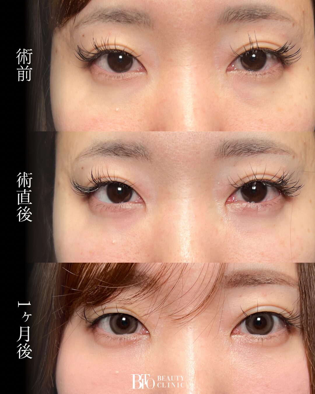 230.切らないクマ取り(脱脂術)
