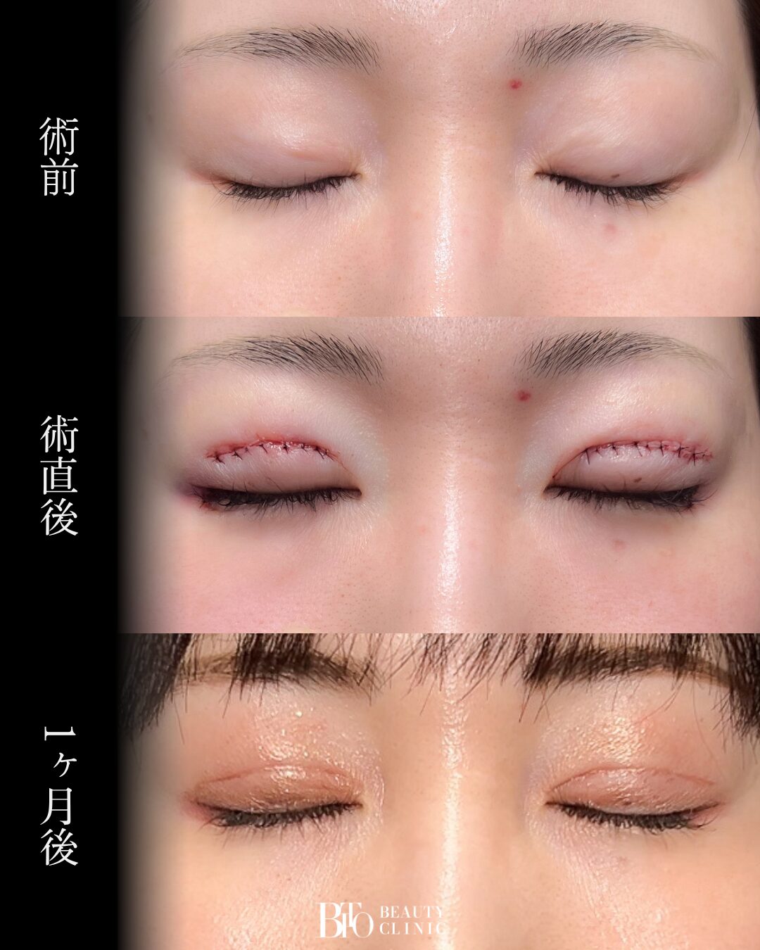 227.二重全切開・目尻切開+目尻靭帯移動