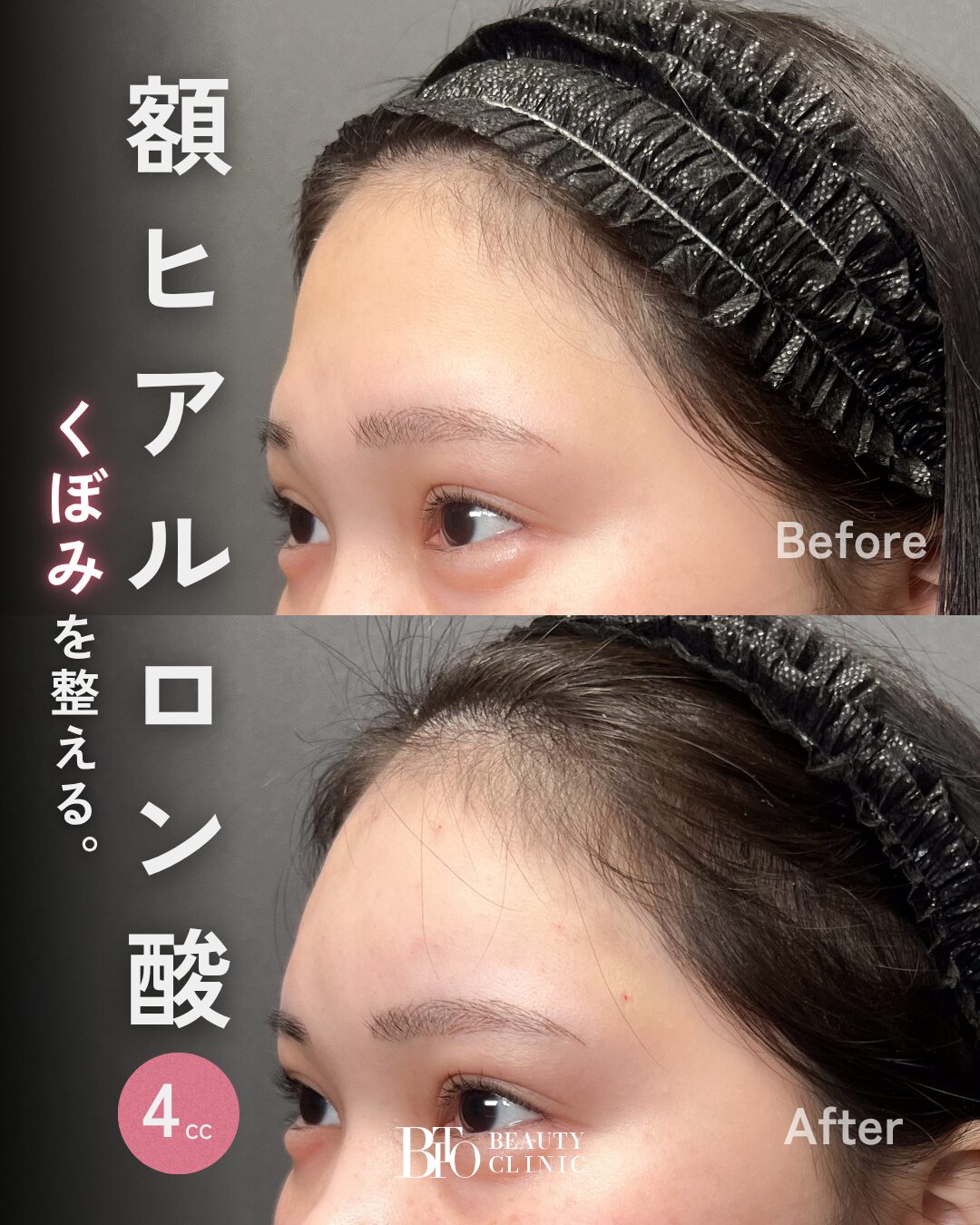 237.額のヒアルロン酸注射