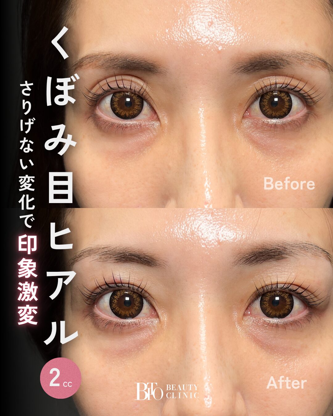 233.40代女性 くぼみ目ヒアルロン酸