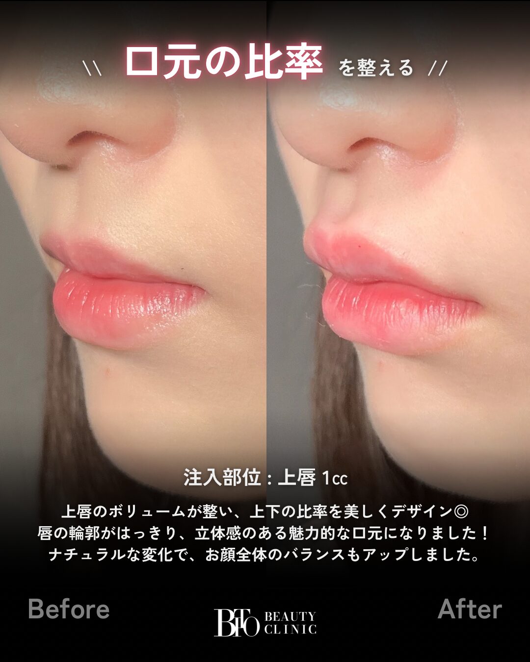 236.20代女性 唇のヒアルロン酸注射