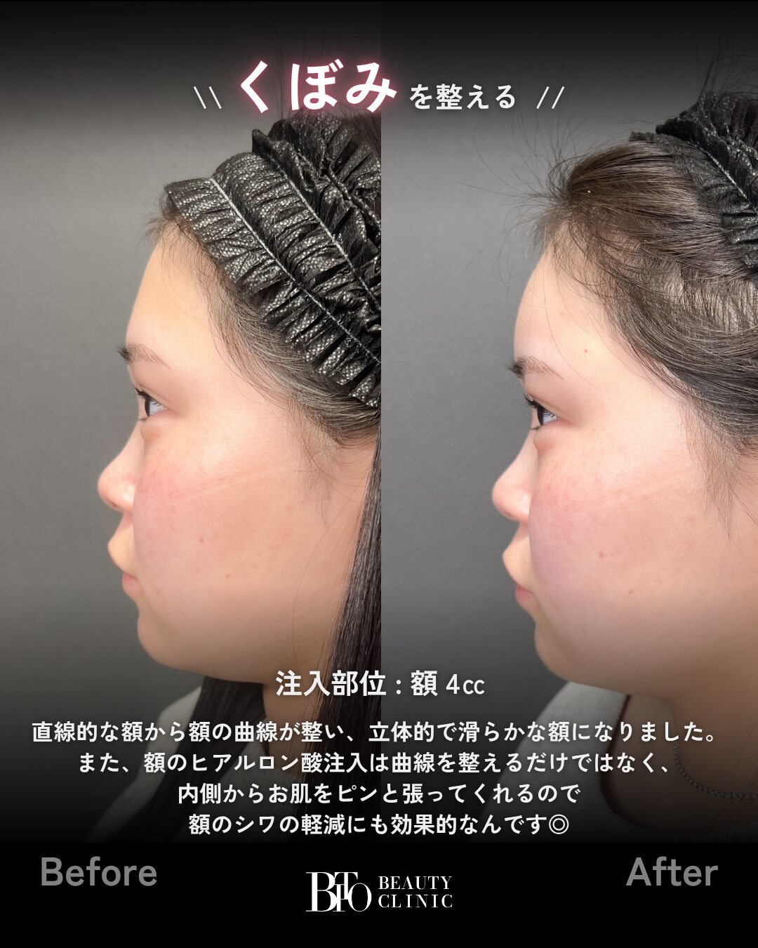 237.額のヒアルロン酸注射