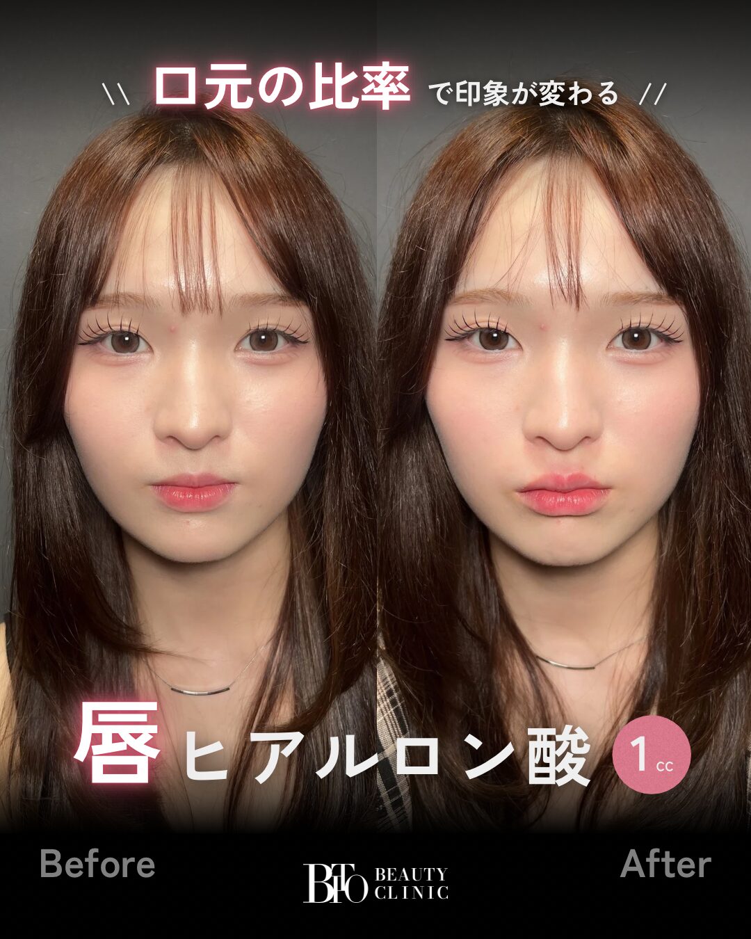 236.20代女性 唇のヒアルロン酸注射