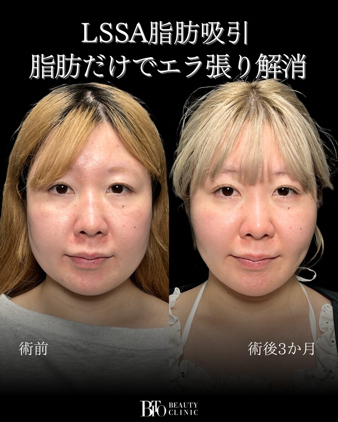 234.30代女性 顔のLSSA脂肪吸引