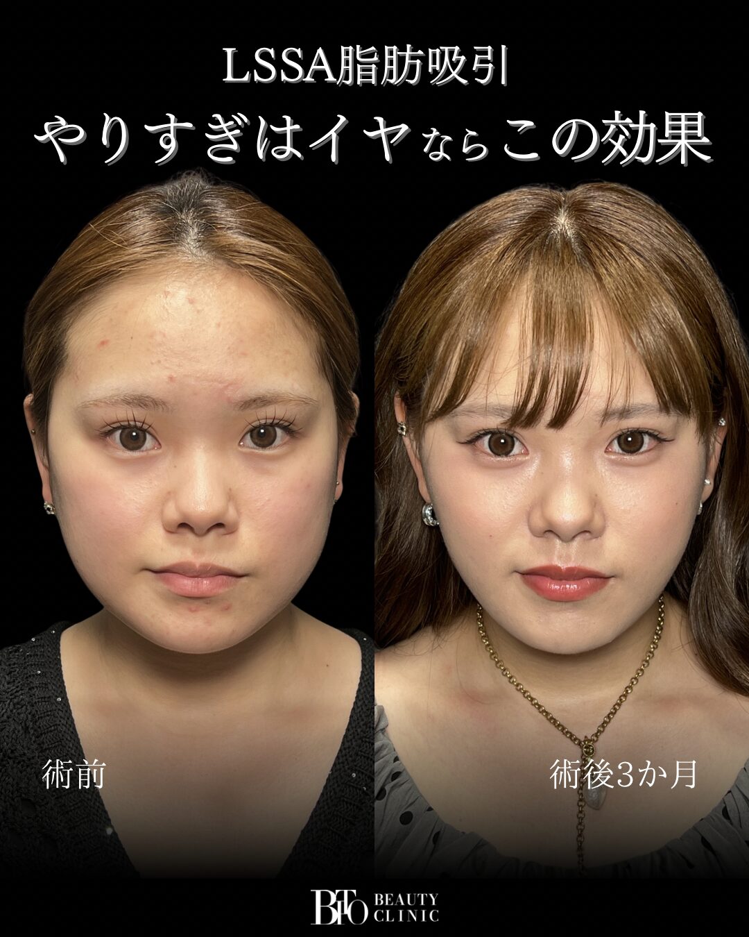 237.20代女性 顔のLSSA脂肪吸引
