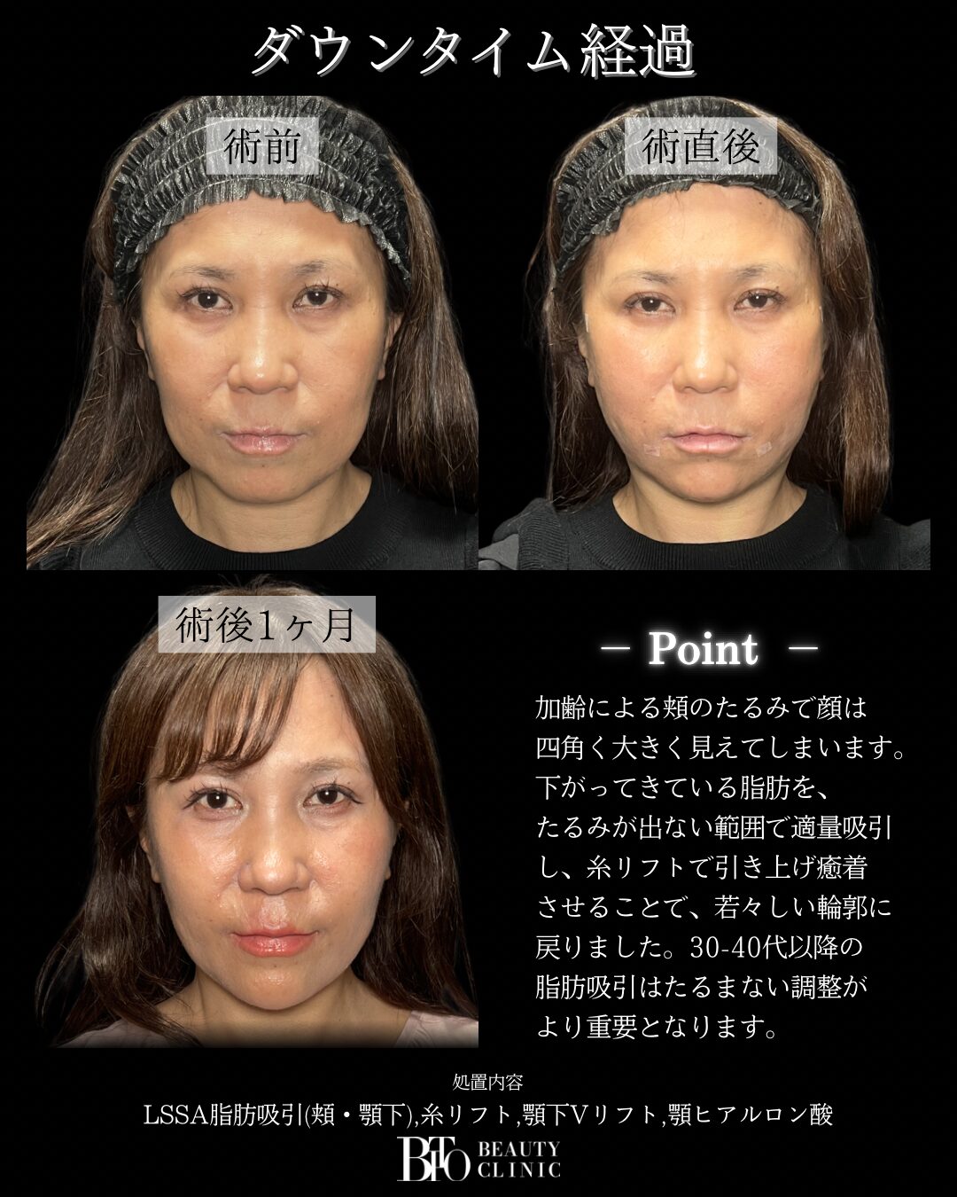 247.顔の脂肪吸引