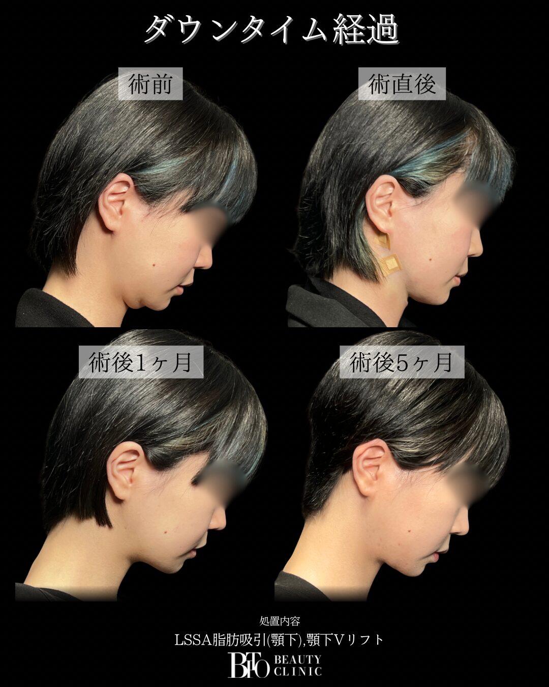 248.20代女性 顔のLSSA脂肪吸引