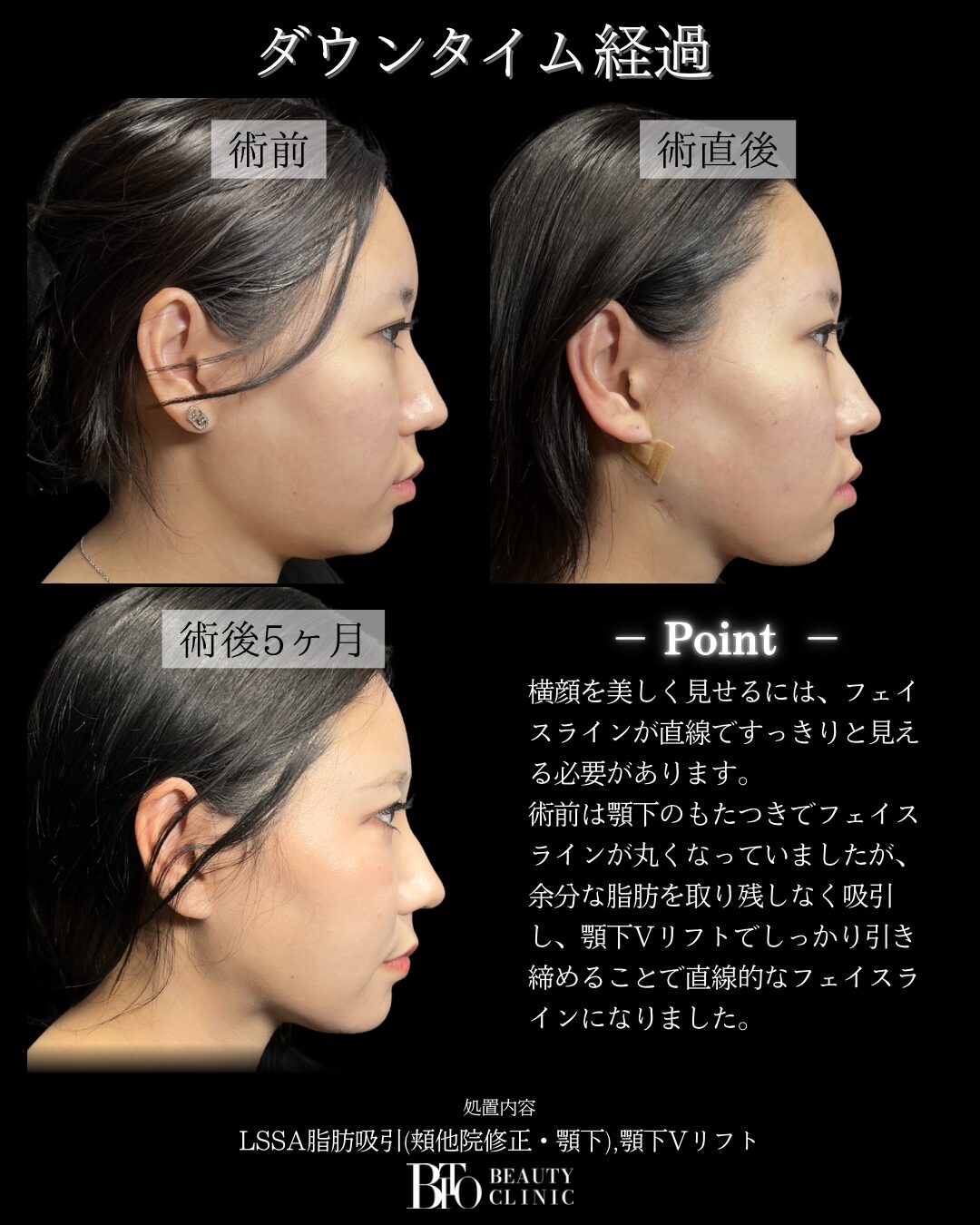 249.20代女性 顔の脂肪吸引