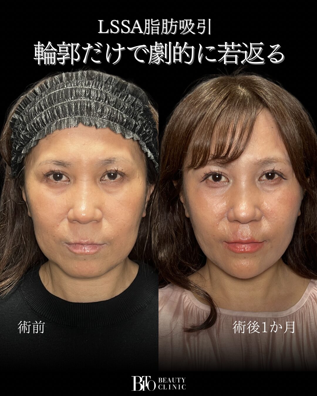 247.顔の脂肪吸引