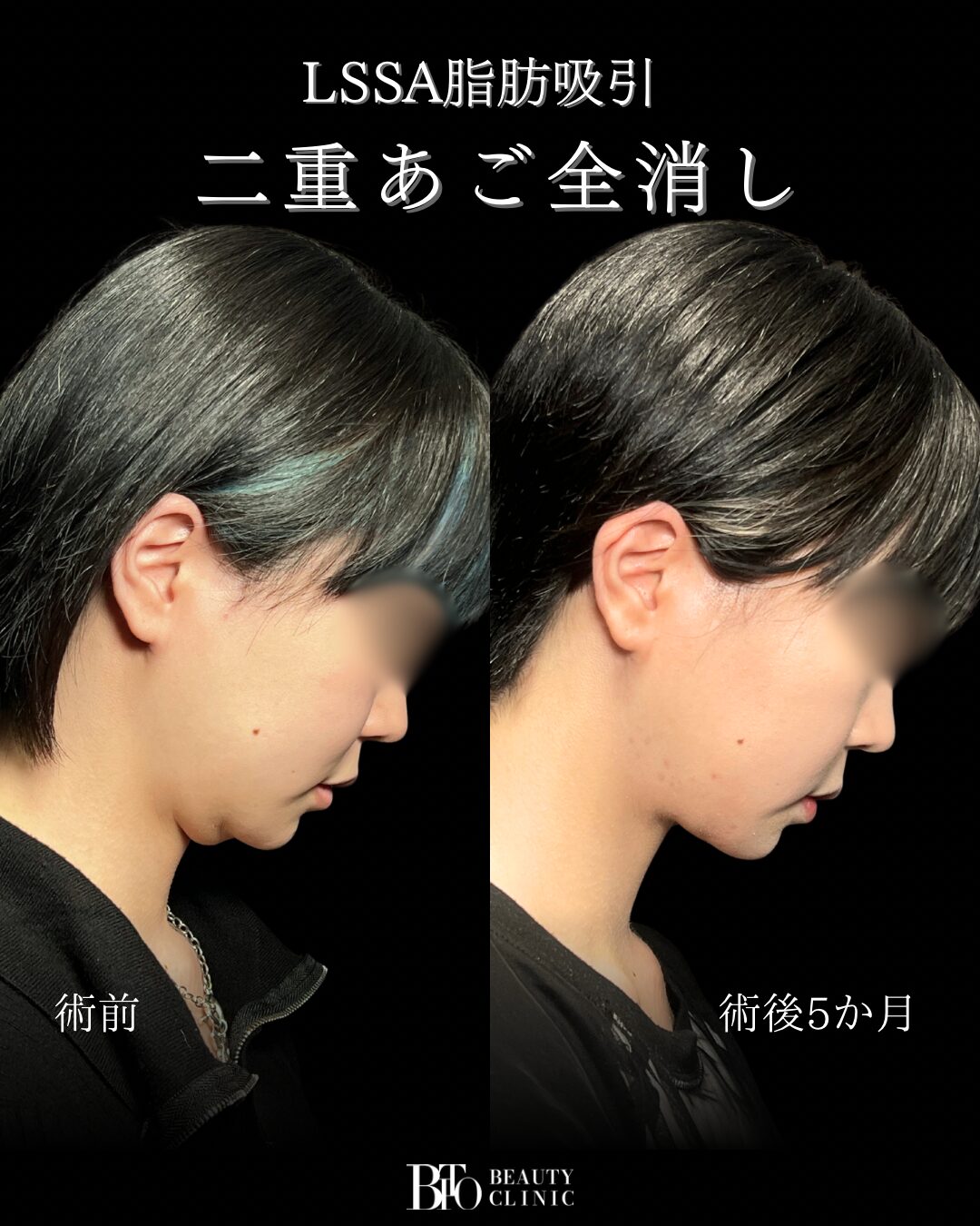 248.20代女性 顔のLSSA脂肪吸引