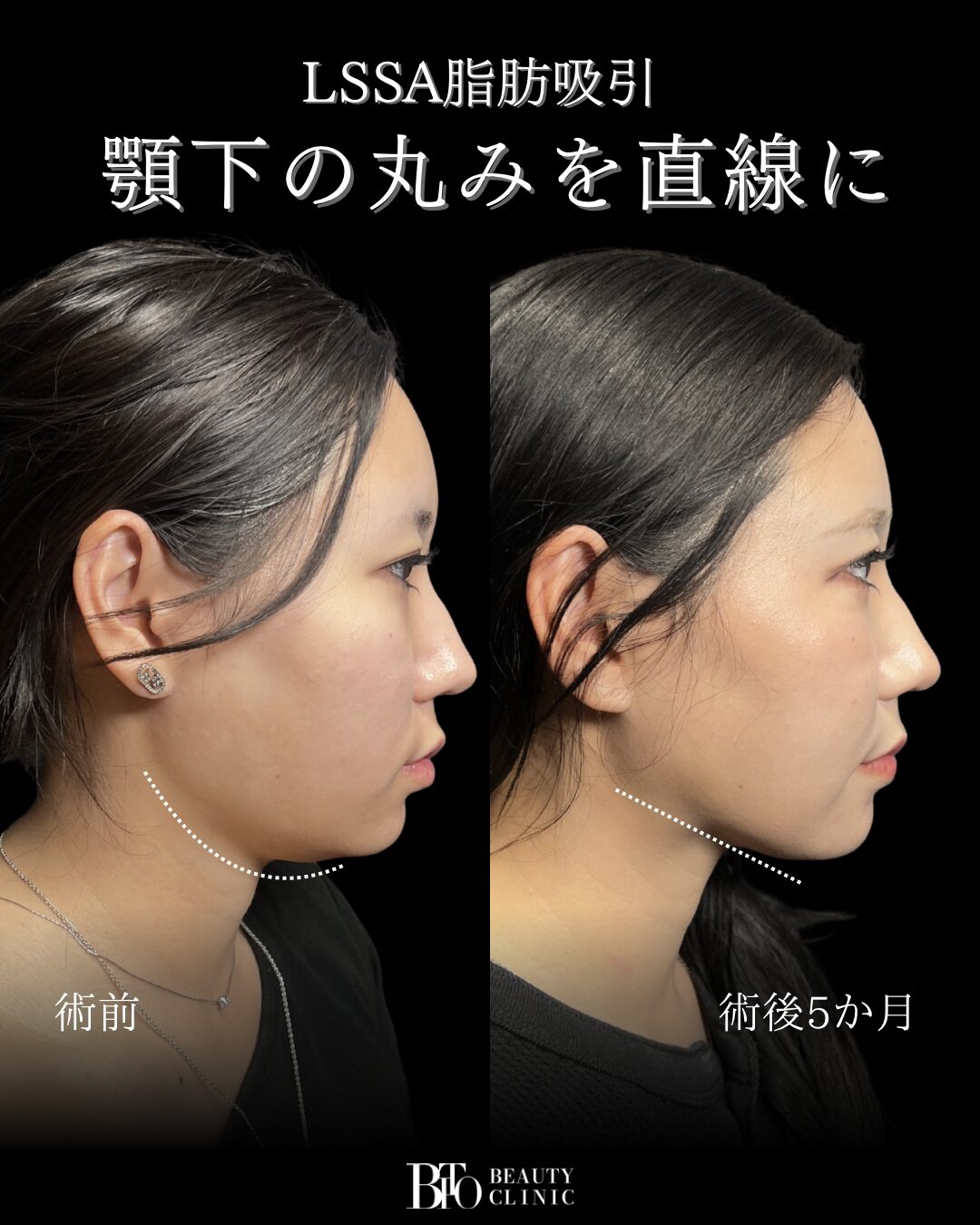 249.20代女性 顔の脂肪吸引