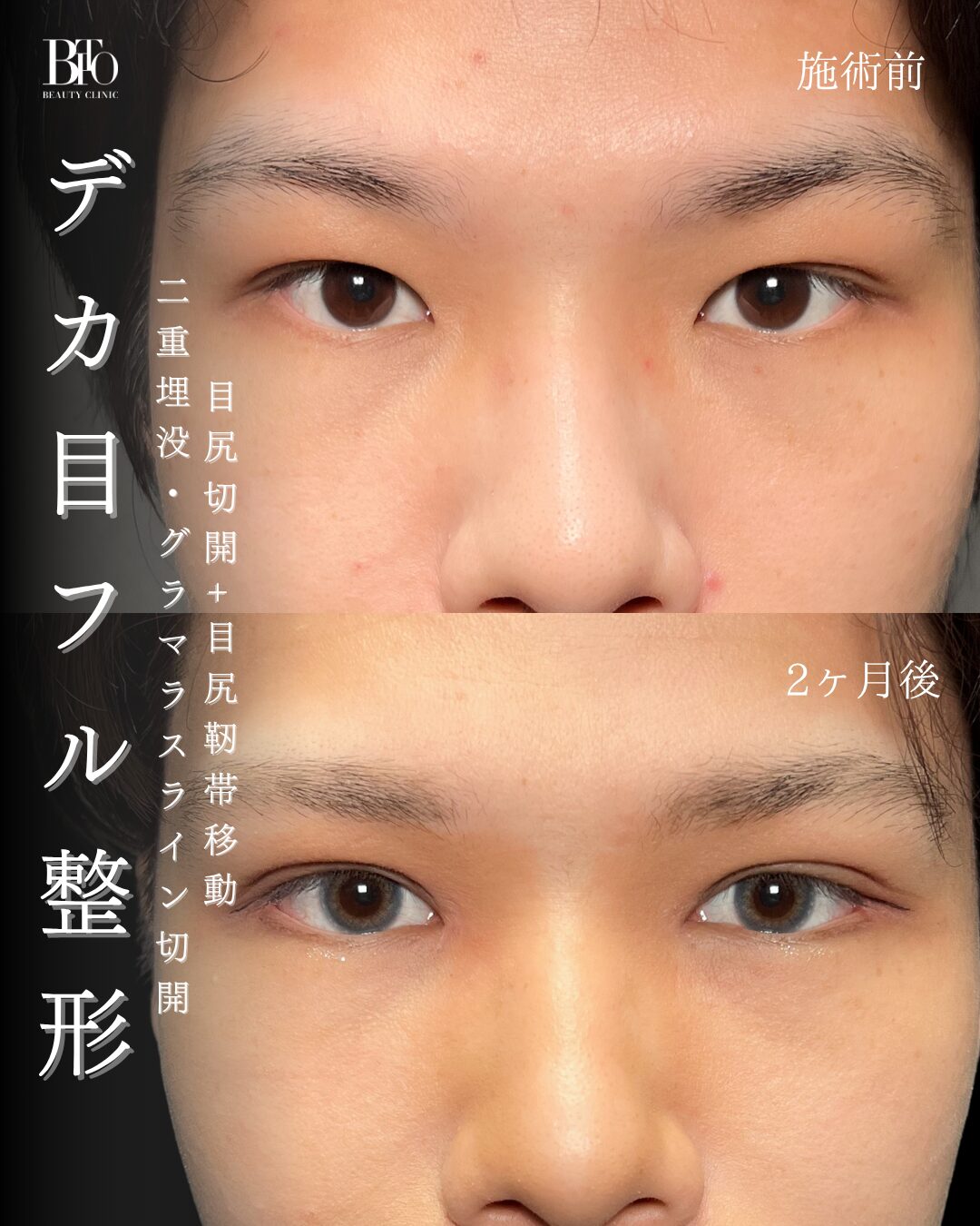 225.20代男性 目元フル整形