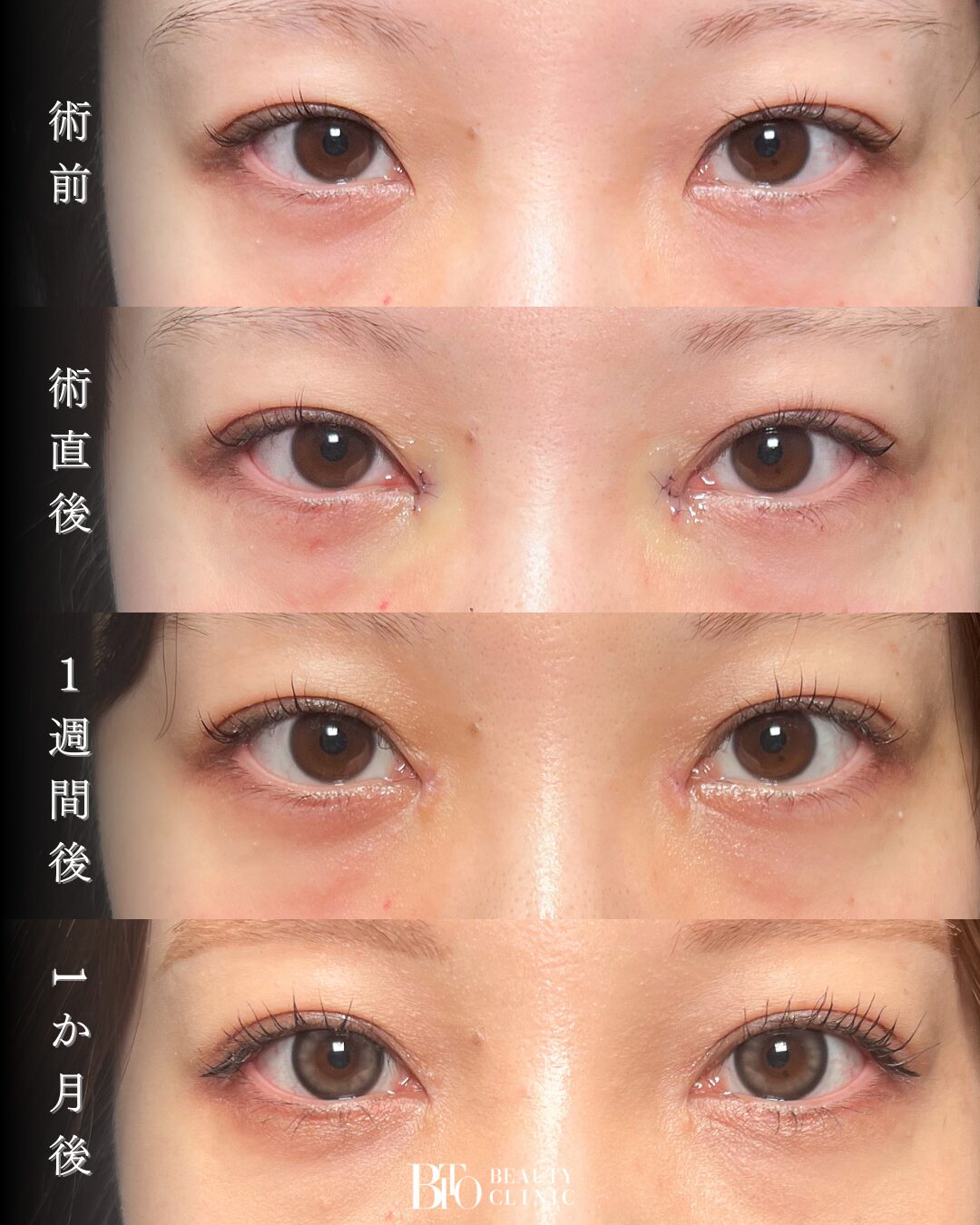 242.目頭切開