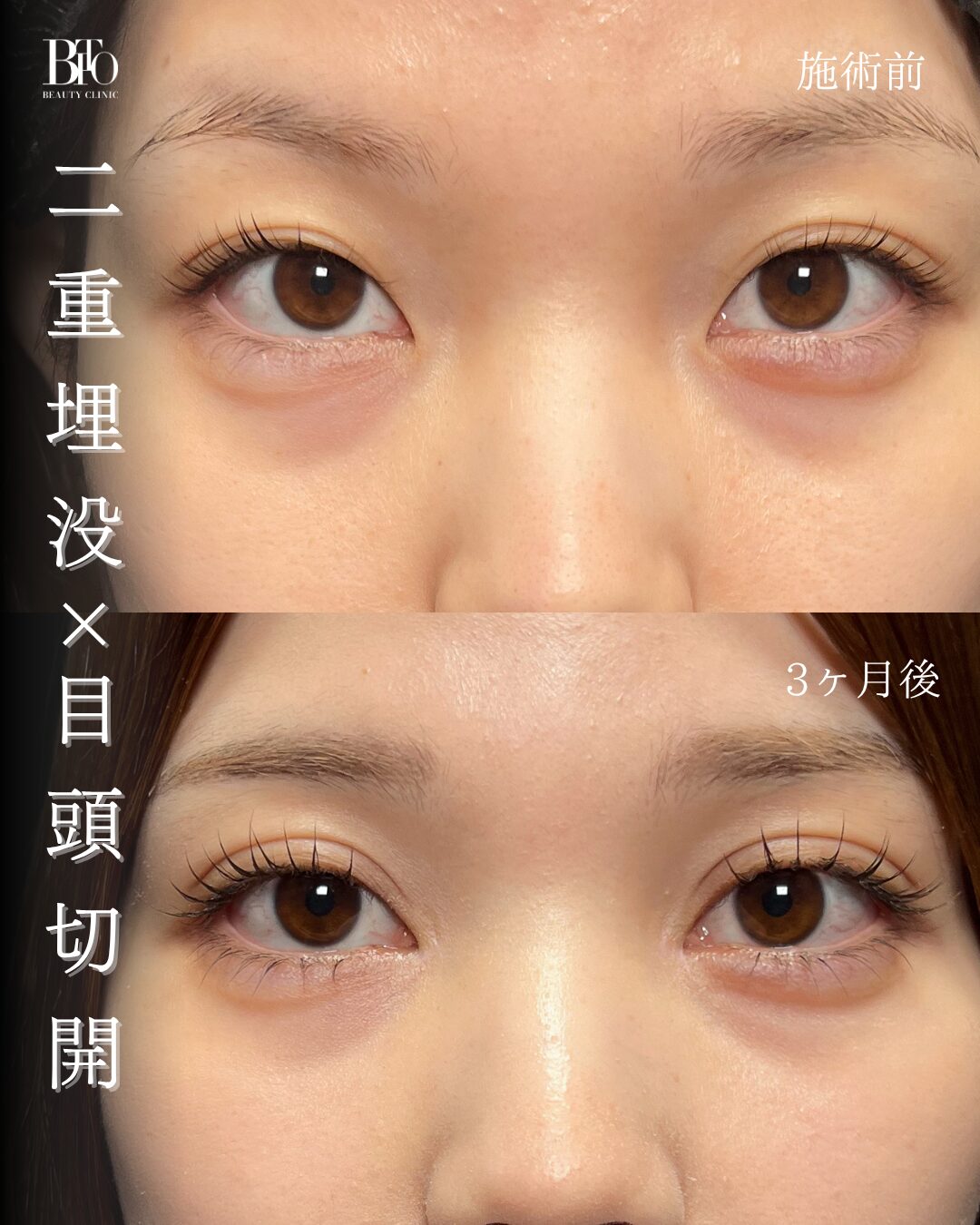 245.二重埋没法・目頭切開