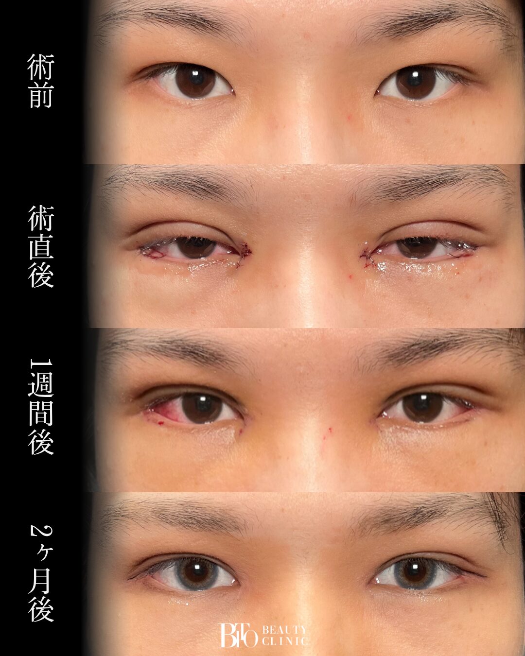 225.20代男性 目元フル整形
