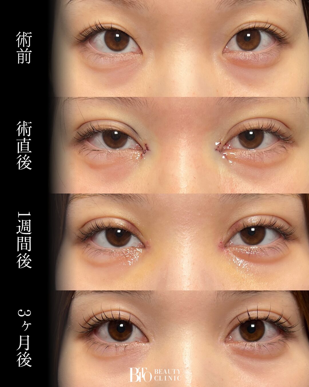 245.二重埋没法・目頭切開