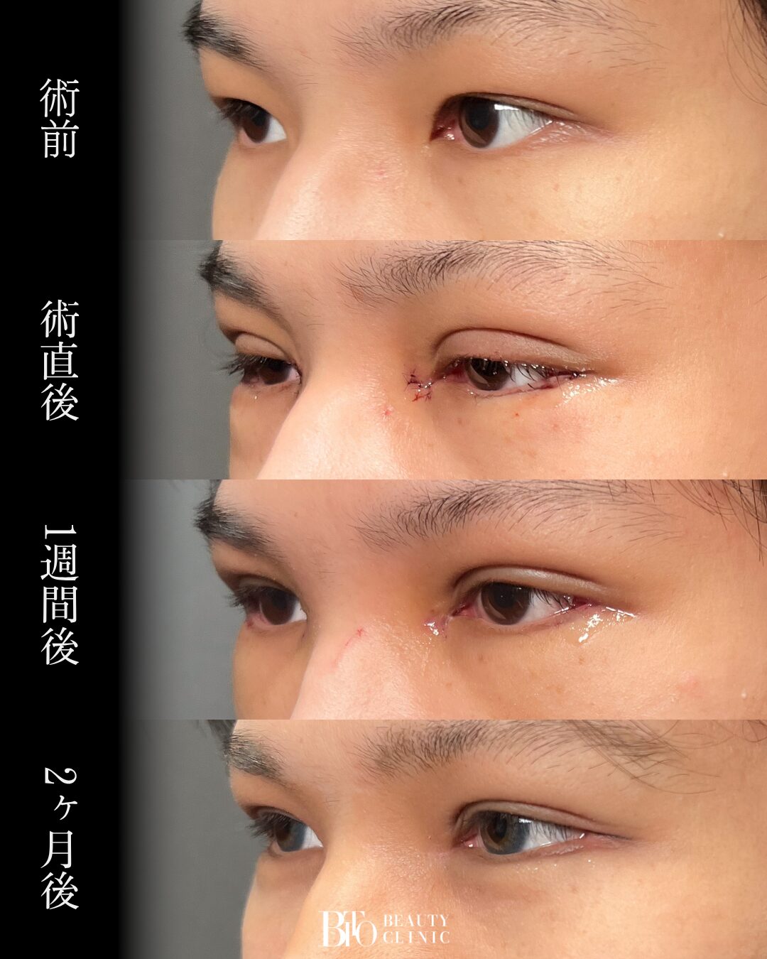225.20代男性 目元フル整形
