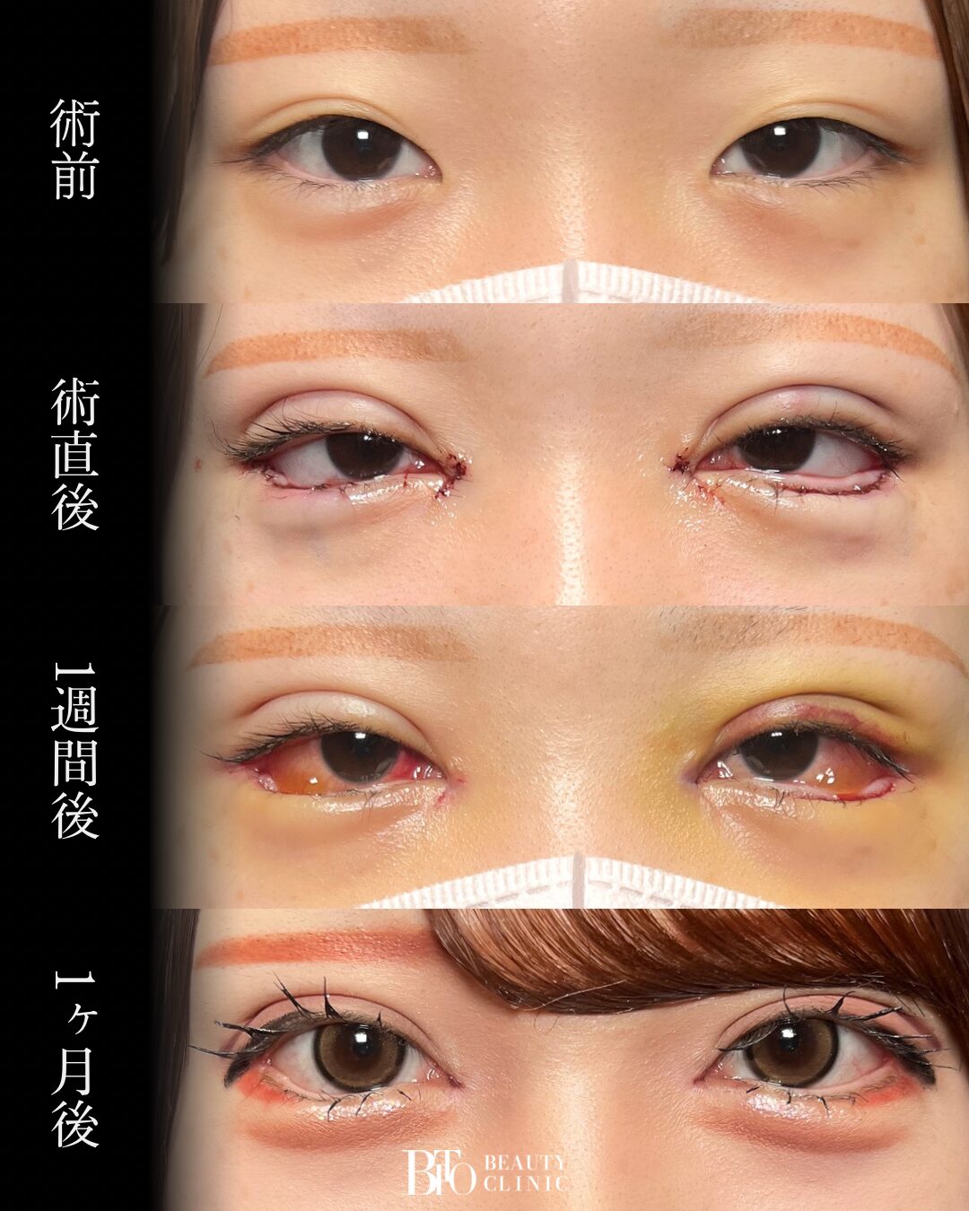 239.目元フル整形