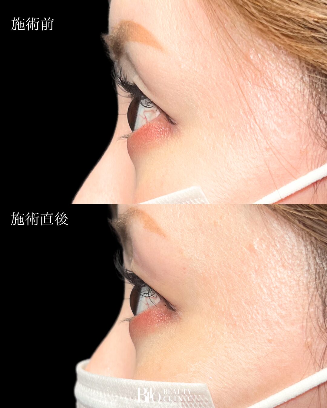 243.30代女性 くぼみ目のヒアルロン酸注入