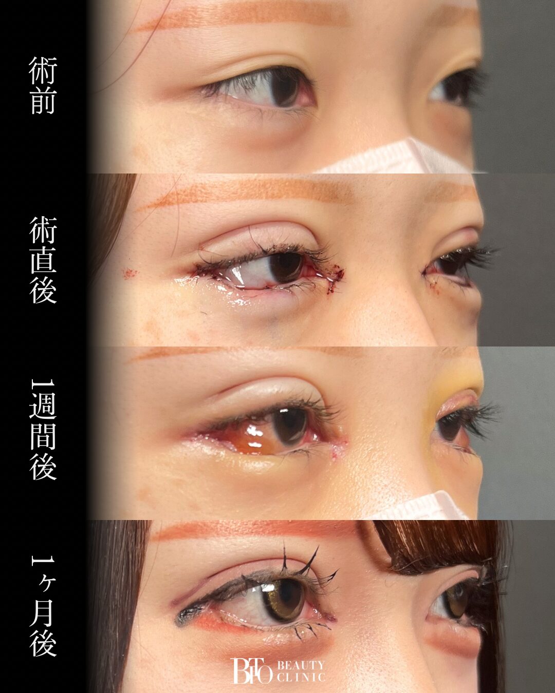 239.目元フル整形