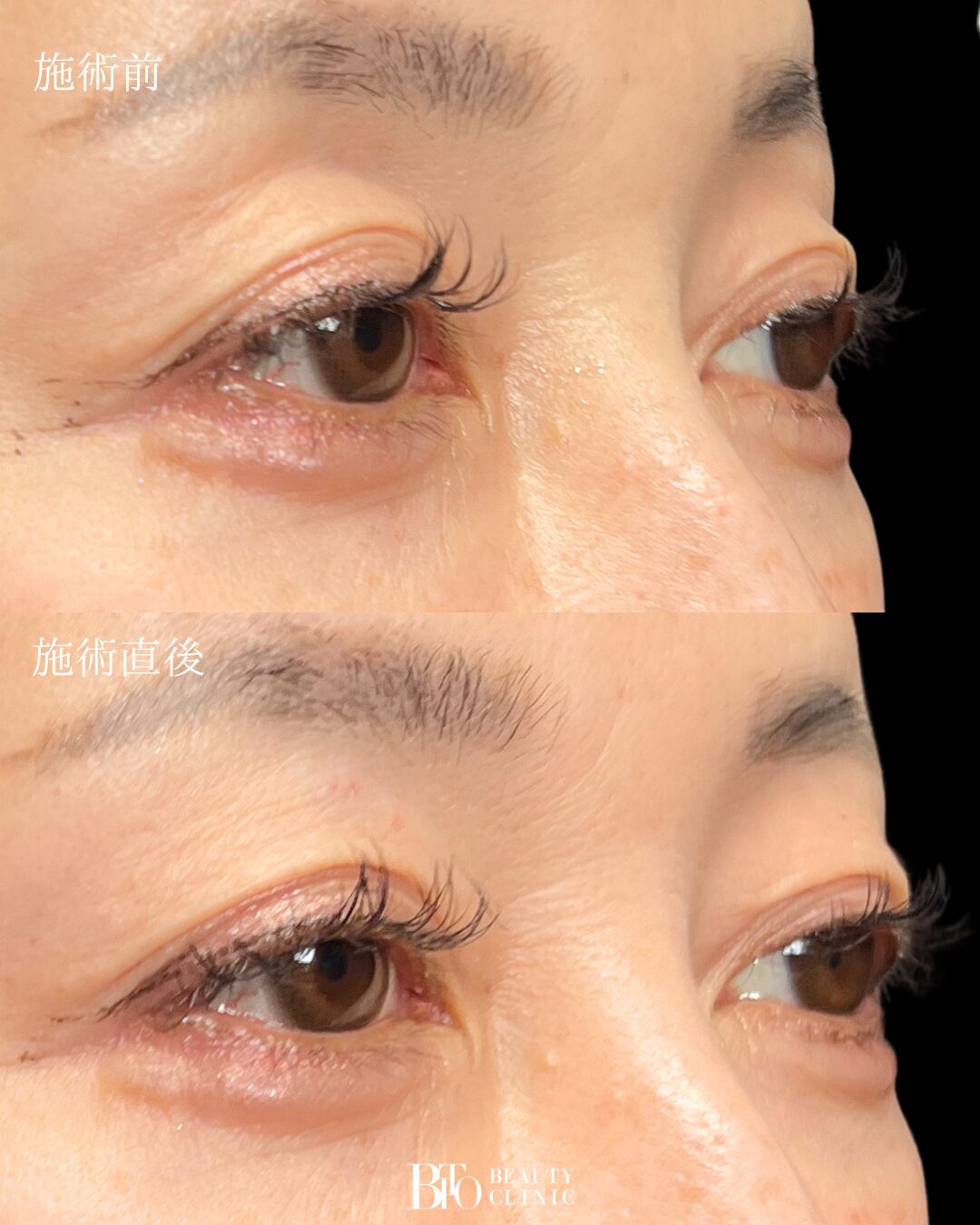 241.50代女性 くぼみ目ヒアルロン酸注入