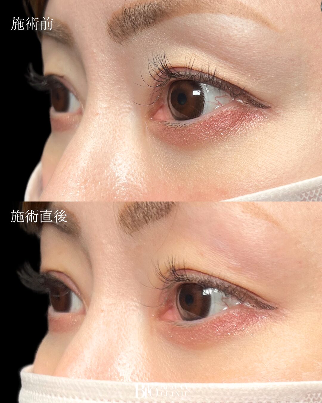 243.30代女性 くぼみ目のヒアルロン酸注入