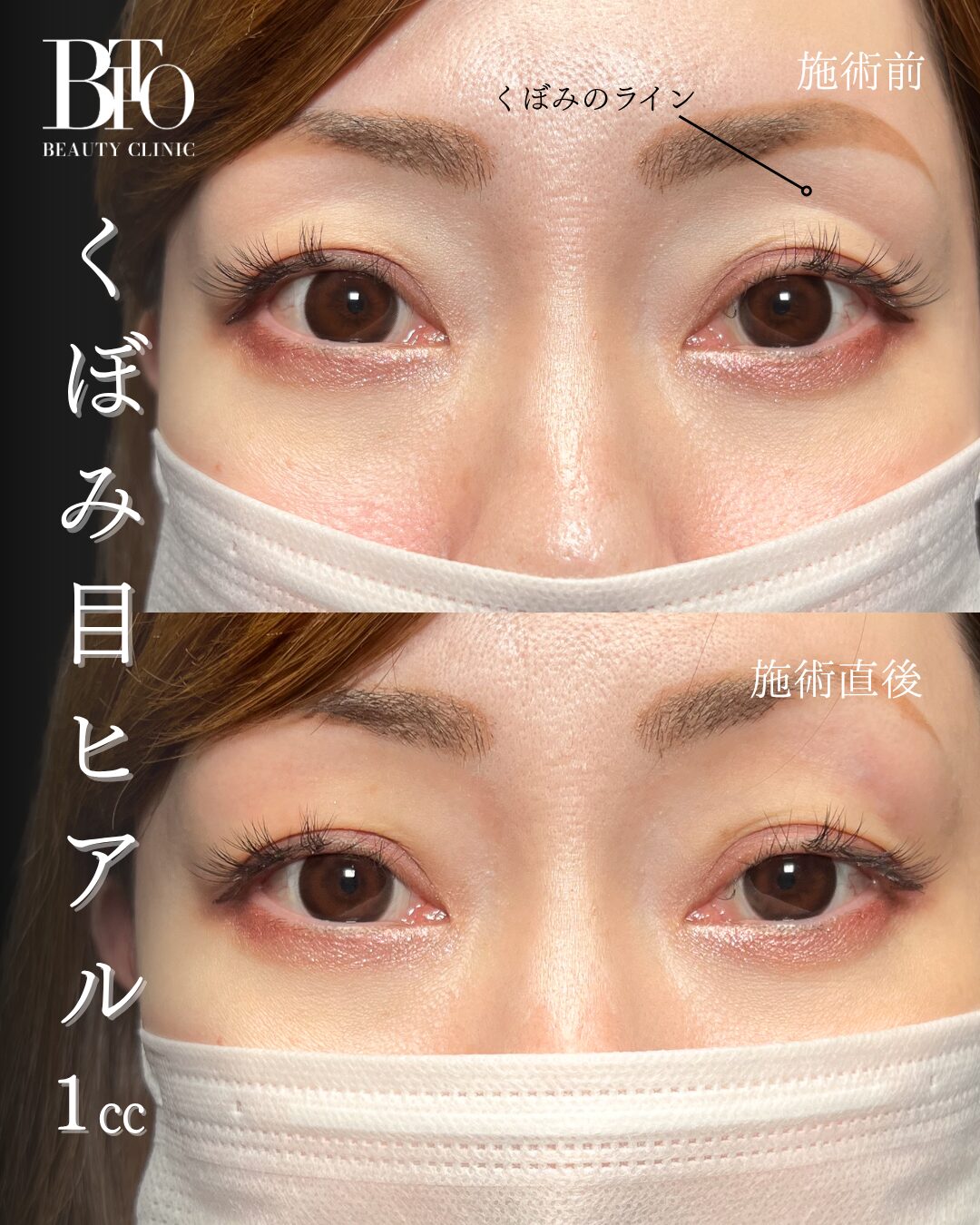 243.30代女性 くぼみ目のヒアルロン酸注入