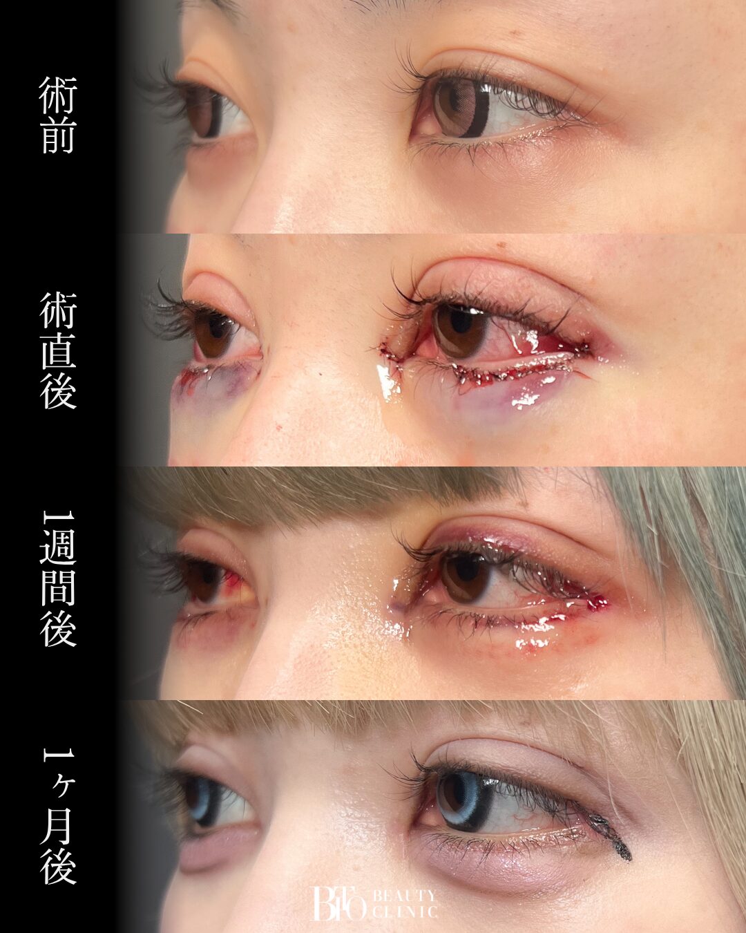 240.目元フル整形