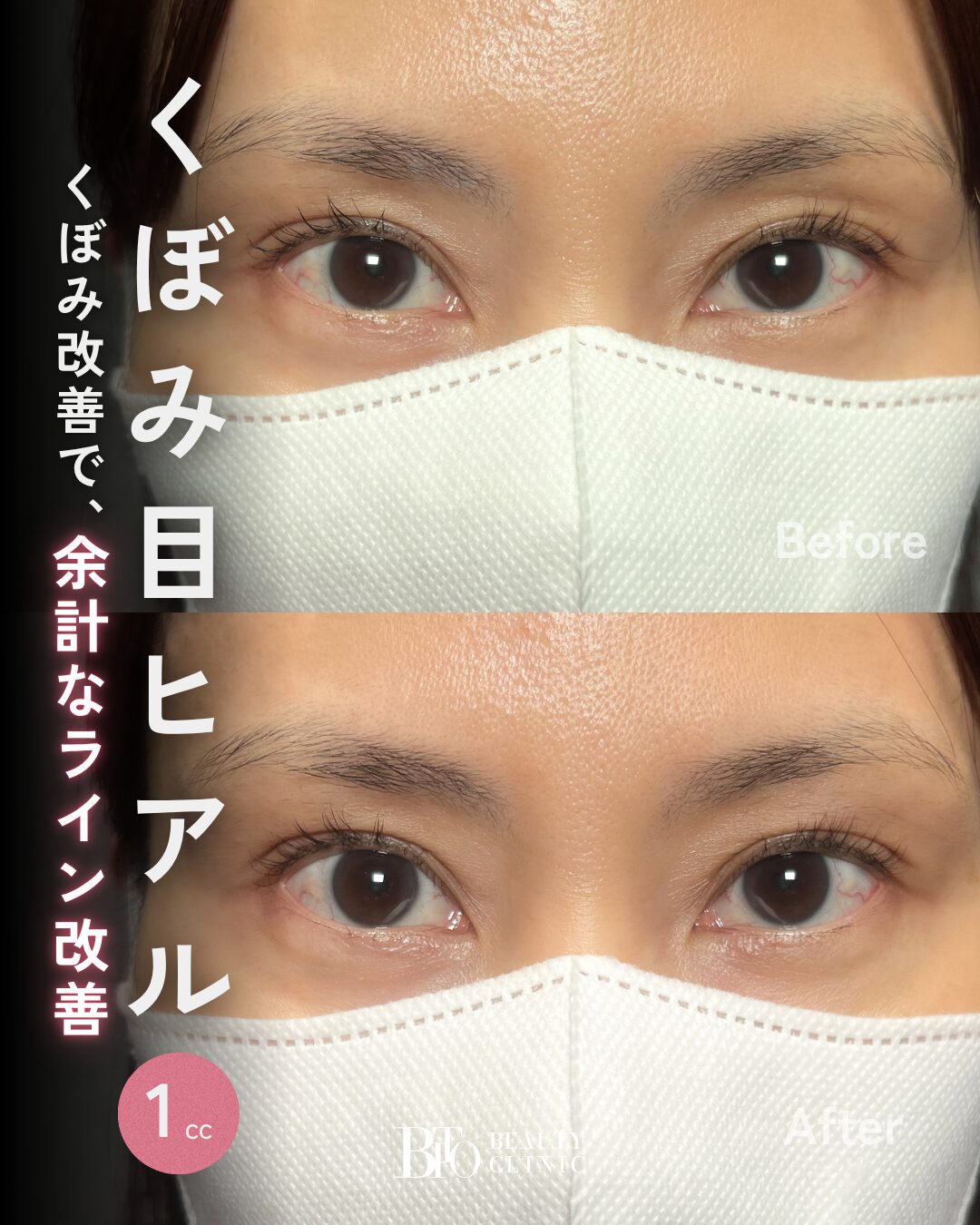 230.40代女性 くぼみ目ヒアルロン酸注入