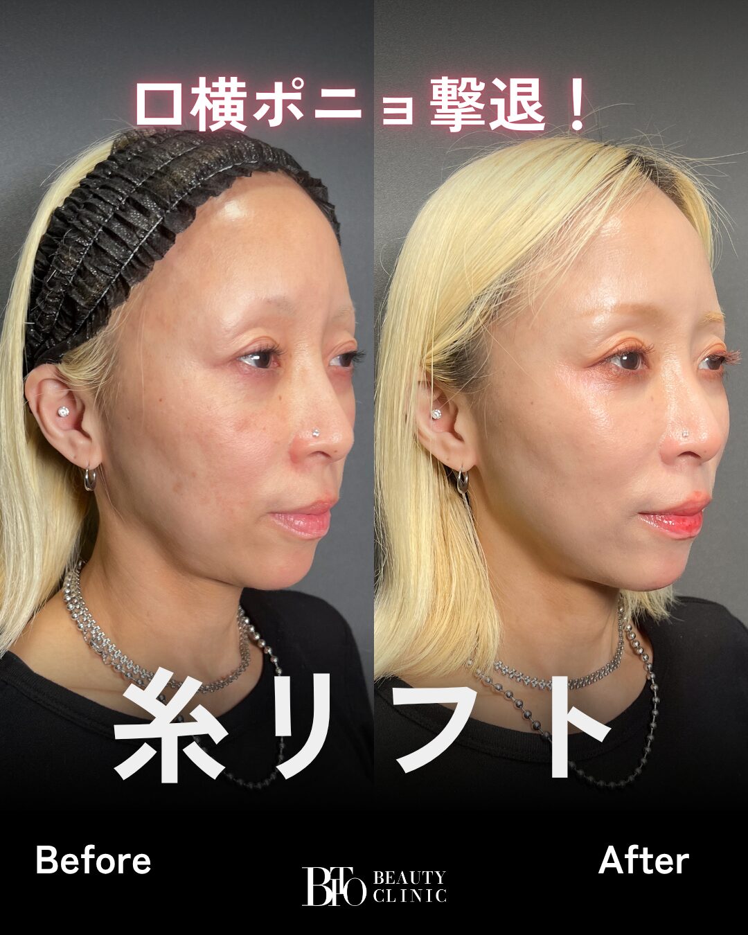 233.糸リフト,ヒアルロン酸注入