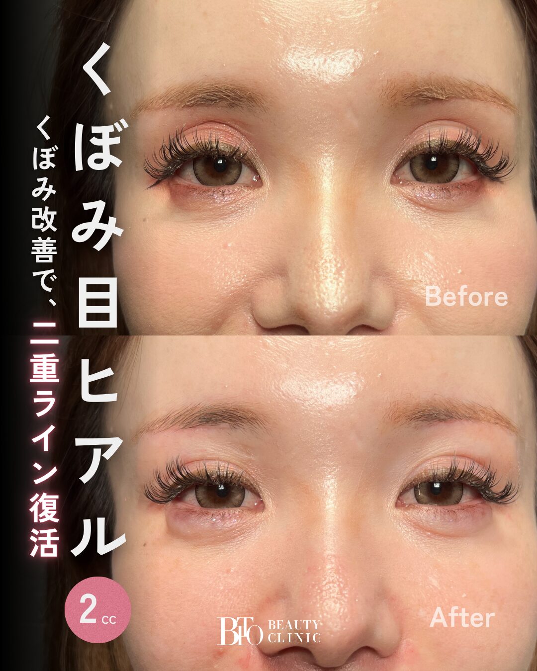 244.30代女性 くぼみ目のヒアルロン酸注入