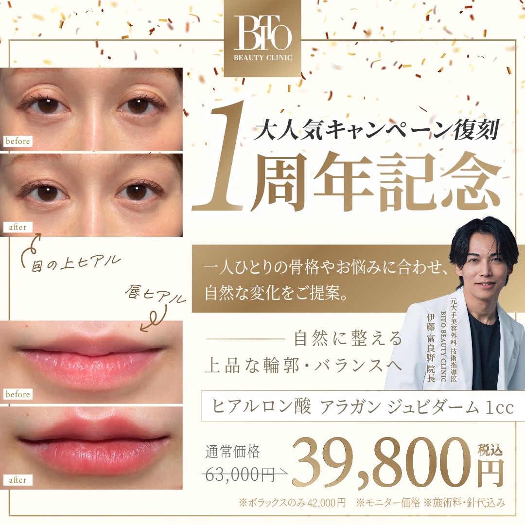 １周年記念✨ヒアルロン酸<ジュビダームビスタ>￥63,000→￥39,800 ※1㏄ 針・麻酔代込