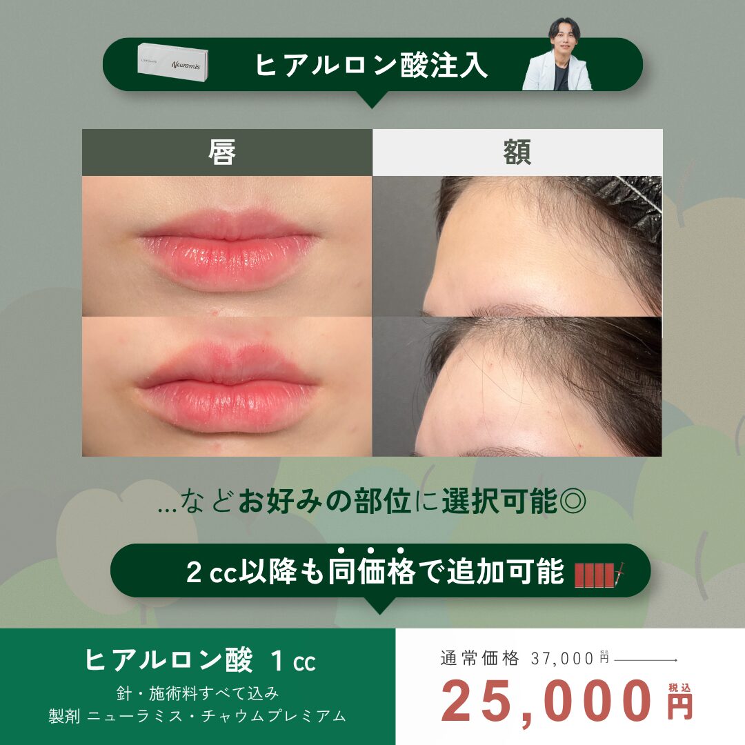 9月キャンペーン : ヒアルロン酸(製剤ニューラミス・チャウムプレミアム) 1㏄ ￥25,000 (針・施術料すべて込)