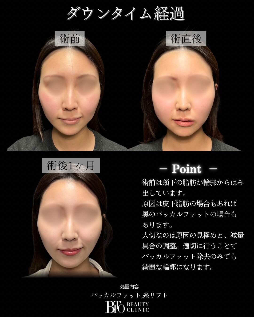 250. 20代女性 バッカルファット除去