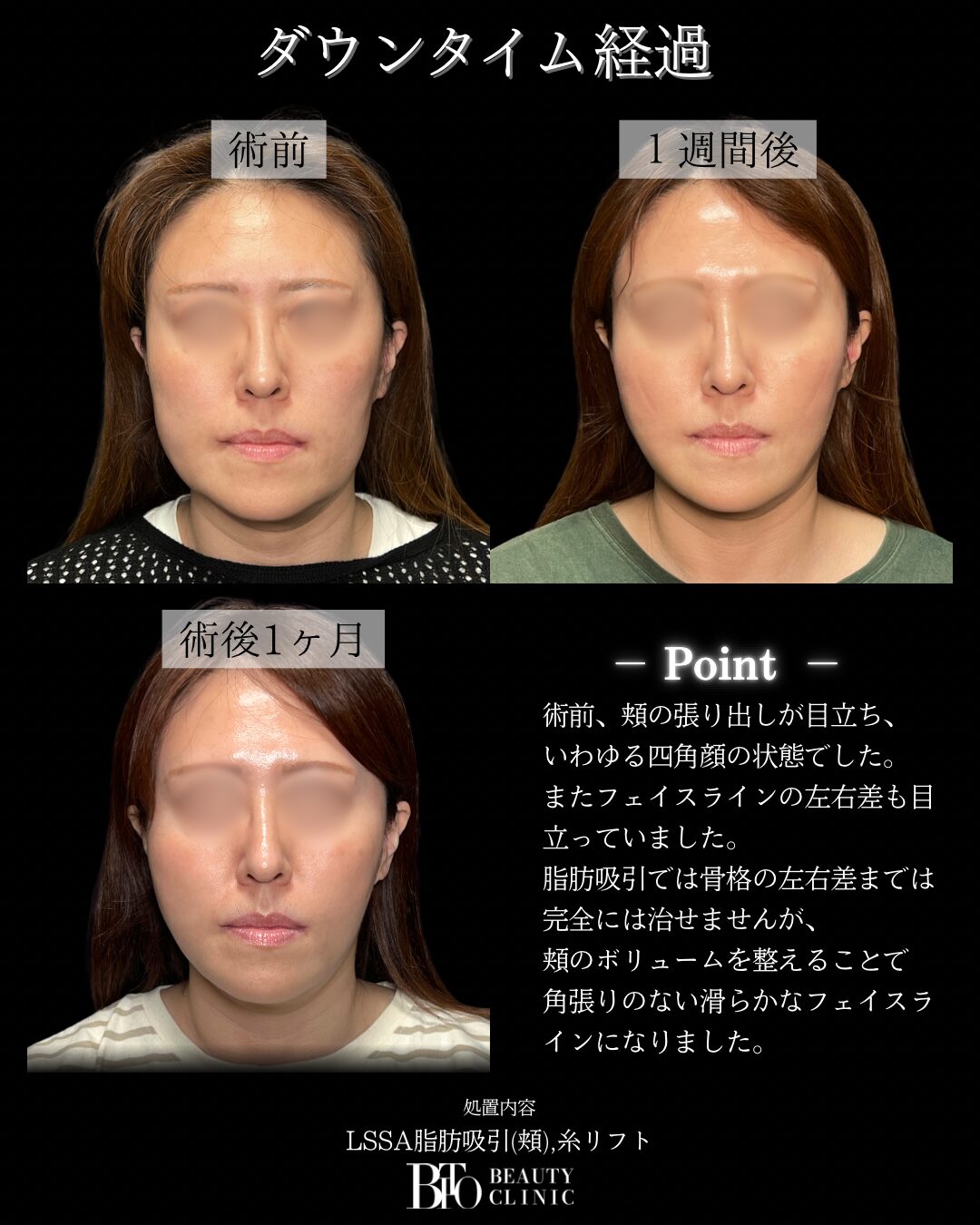 254.40代女性 顔のLSSA脂肪吸引