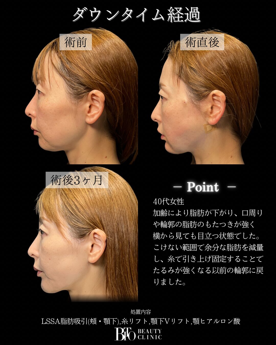 255.40代女性 顔のLSSA脂肪吸引