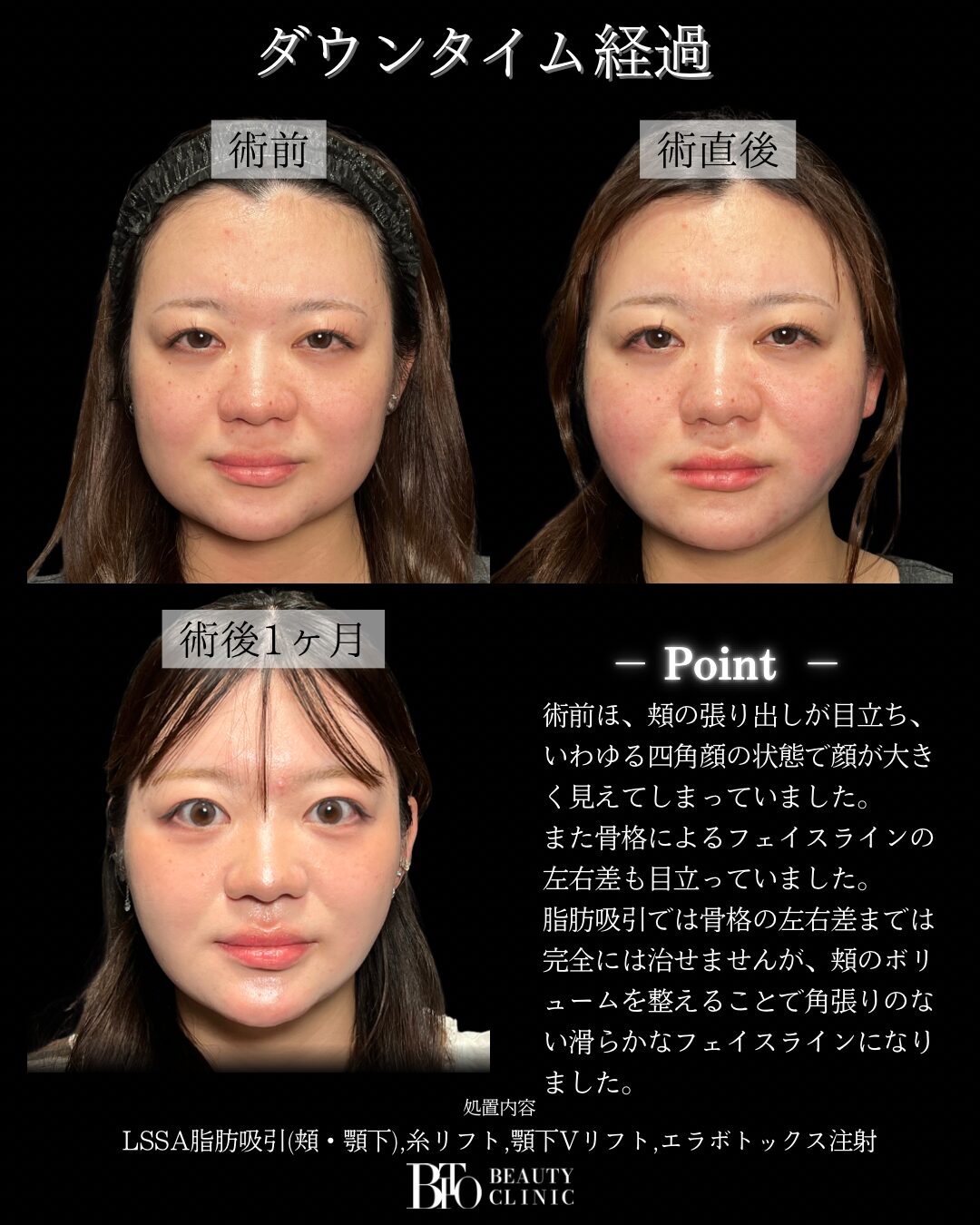 256.20代女性 顔の脂肪吸引