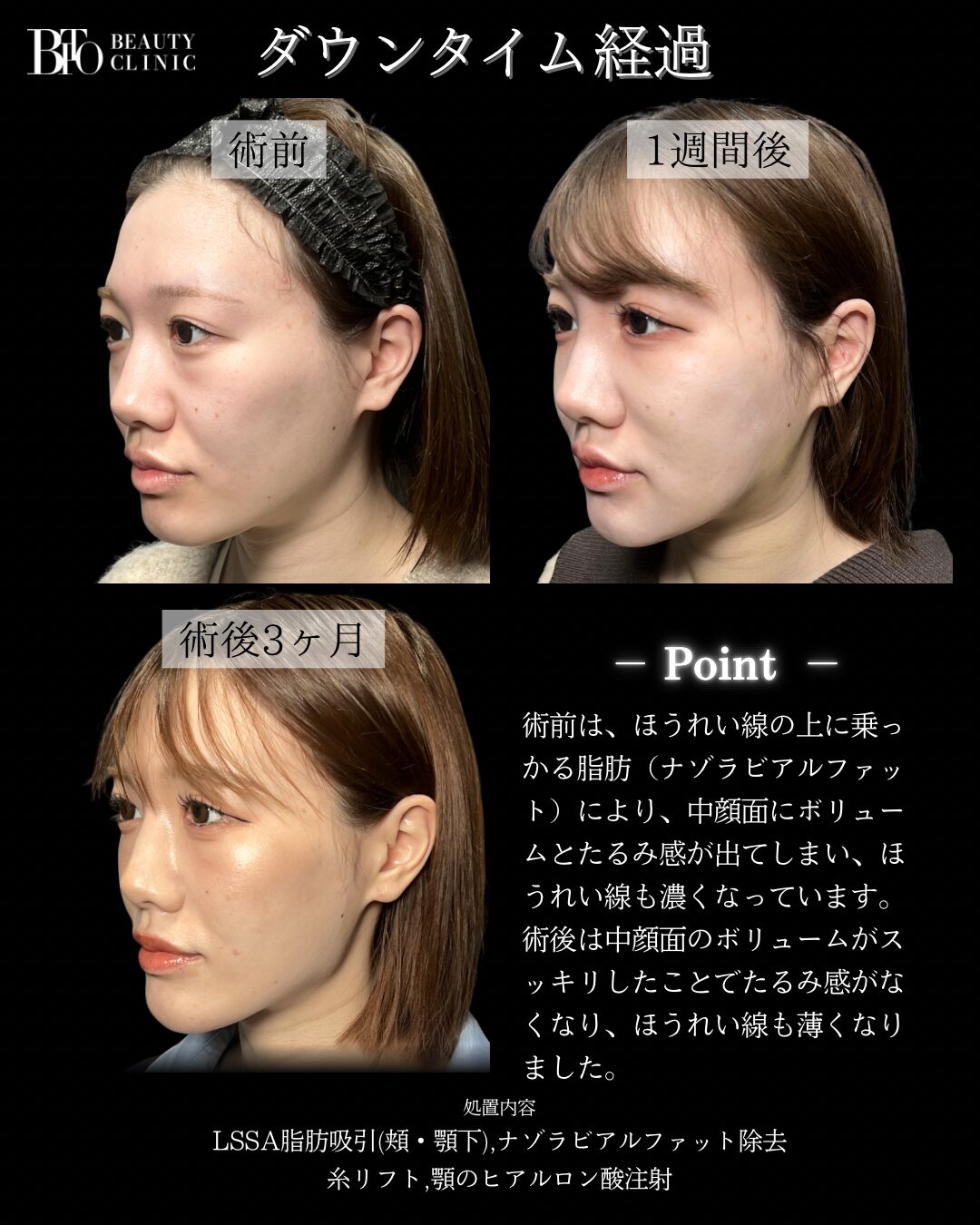 257.20代女性 顔のLSSA脂肪吸引