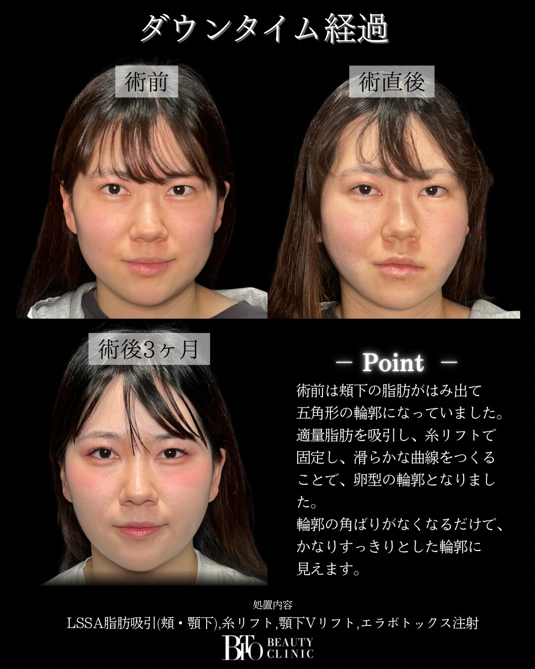 260.20代女性 顔のLSSA脂肪吸引