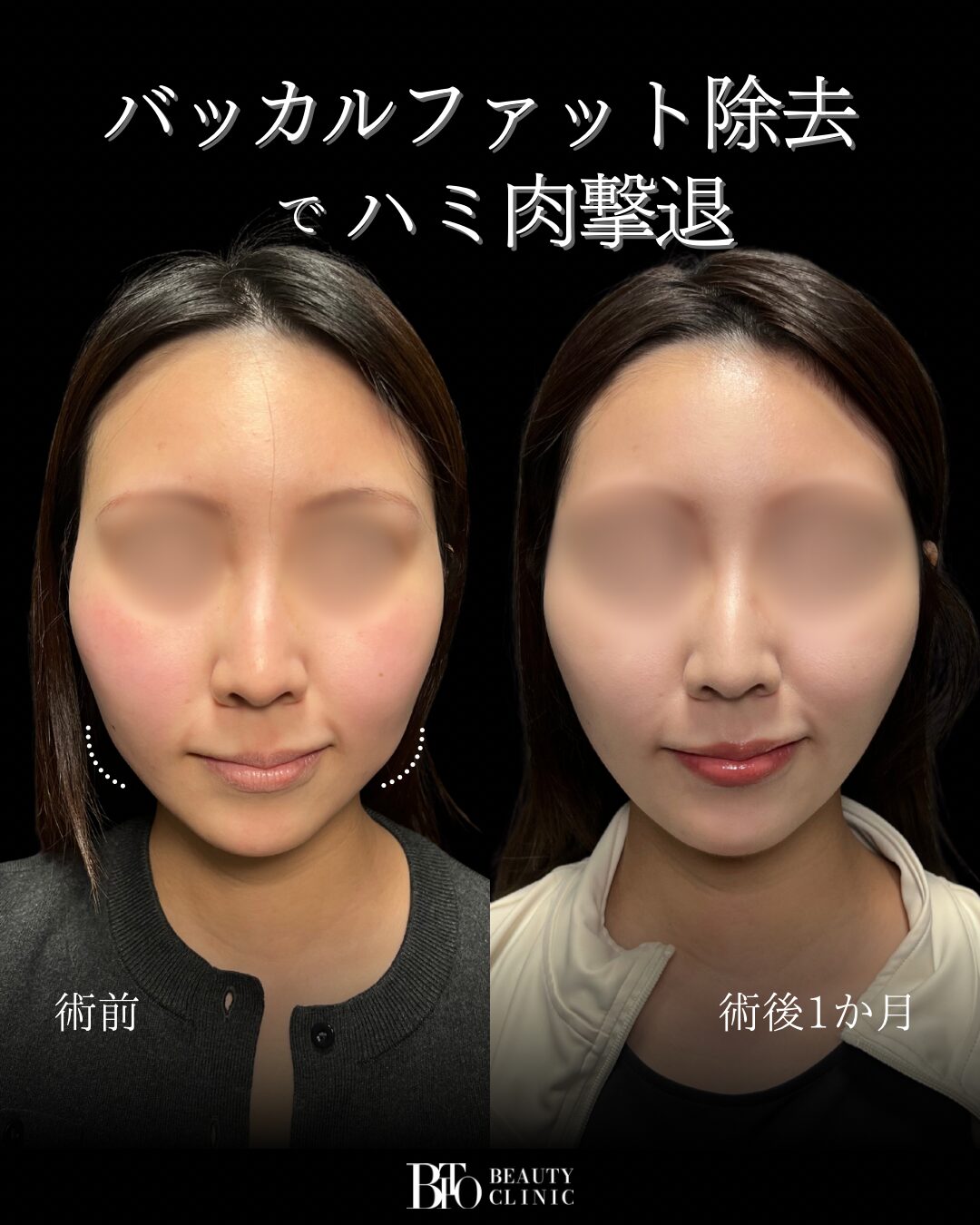 250. 20代女性 バッカルファット除去